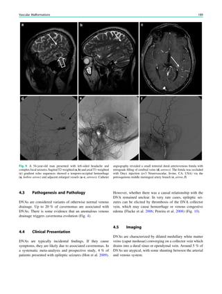 4.3 Pathogenesis and Pathology
DVAs are considered variants of otherwise normal venous
drainage. Up to 20 % of cavernomas are associated with
DVAs. There is some evidence that an anomalous venous
drainage triggers cavernoma evolution (Fig. 4).
4.4 Clinical Presentation
DVAs are typically incidental ﬁndings. If they cause
symptoms, they are likely due to associated cavernomas. In
a systematic meta-analysis and prospective study, 4 % of
patients presented with epileptic seizures (Hon et al. 2009).
However, whether there was a causal relationship with the
DVA remained unclear. In very rare cases, epileptic sei-
zures can be elicited by thrombosis of the DVA collector
vein, which may cause hemorrhage or venous congestive
edema (Flacke et al. 2006; Pereira et al. 2008) (Fig. 10).
4.5 Imaging
DVAs are characterized by dilated medullary white matter
veins (caput medusae) converging on a collector vein which
drains into a dural sinus or ependymal vein. Around 5 % of
DVAs are atypical, with some shunting between the arterial
and venous system.
Fig. 9 A 54-year-old man presented with left-sided headache and
complexfocalseizures. SagittalT2-weighted(a,b)andaxialT1-weighted
(c) gradient echo sequences showed a temporo-occipital hemorrhage
(a, hollow arrow) and adjacent enlarged vessels (a–c, arrows). Catheter
angiography revealed a small tentorial dural arteriovenous ﬁstula with
retrograde ﬁlling of cerebral veins (d, arrows). The ﬁstula was occluded
with Onyx injection (ev3 Neurovascular, Irvine, CA, USA) via the
petrosqamous middle meningeal artery branch (e, arrow, f)
Vascular Malformations 189
 