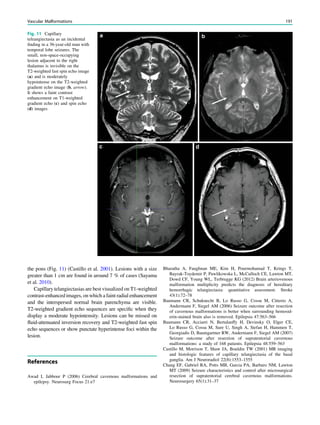 the pons (Fig. 11) (Castillo et al. 2001). Lesions with a size
greater than 1 cm are found in around 7 % of cases (Sayama
et al. 2010).
Capillary telangiectasias are best visualized on T1-weighted
contrast-enhanced images, on which a faint radial enhancement
and the interspersed normal brain parenchyma are visible.
T2-weighted gradient echo sequences are speciﬁc when they
display a moderate hypointensity. Lesions can be missed on
ﬂuid-attenuated inversion recovery and T2-weighted fast spin
echo sequences or show punctate hyperintense foci within the
lesion.
References
Awad I, Jabbour P (2006) Cerebral cavernous malformations and
epilepsy. Neurosurg Focus 21:e7
Bharatha A, Faughnan ME, Kim H, Pourmohamad T, Krings T,
Bayrak-Toydemir P, Pawlikowska L, McCulloch CE, Lawton MT,
Dowd CF, Young WL, Terbrugge KG (2012) Brain arteriovenous
malformation multiplicity predicts the diagnosis of hereditary
hemorrhagic telangiectasia: quantitative assessment. Stroke
43(1):72–78
Baumann CR, Schuknecht B, Lo Russo G, Cossu M, Citterio A,
Andermann F, Siegel AM (2006) Seizure outcome after resection
of cavernous malformations is better when surrounding hemosid-
erin-stained brain also is removed. Epilepsia 47:563–566
Baumann CR, Acciarri N, Bertalanffy H, Devinsky O, Elger CE,
Lo Russo G, Cossu M, Sure U, Singh A, Stefan H, Hammen T,
Georgiadis D, Baumgartner RW, Andermann F, Siegel AM (2007)
Seizure outcome after resection of supratentorial cavernous
malformations: a study of 168 patients. Epilepsia 48:559–563
Castillo M, Morrison T, Shaw JA, Bouldin TW (2001) MR imaging
and histologic features of capillary telangiectasia of the basal
ganglia. Am J Neuroradiol 22(8):1553–1555
Chang EF, Gabriel RA, Potts MB, Garcia PA, Barbaro NM, Lawton
MT (2009) Seizure characteristics and control after microsurgical
resection of supratentorial cerebral cavernous malformations.
Neurosurgery 65(1):31–37
Fig. 11 Capillary
teleangiectasia as an incidental
ﬁnding in a 36-year-old man with
temporal lobe seizures. The
small, non-space-occupying
lesion adjacent to the right
thalamus is invisible on the
T2-weighted fast spin echo image
(a) and is moderately
hypointense on the T2-weighted
gradient echo image (b, arrow).
It shows a faint contrast
enhancement on T1-weighted
gradient echo (c) and spin echo
(d) images
Vascular Malformations 191
 