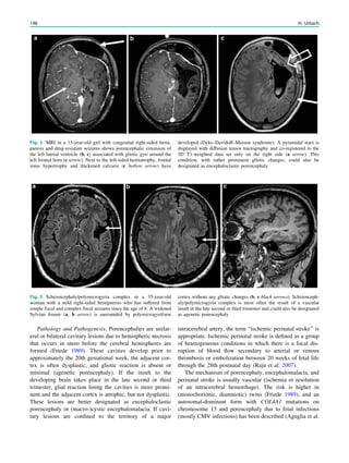 Pathology and Pathogenesis. Porencephalies are unilat-
eral or bilateral cavitary lesions due to hemispheric necrosis
that occurs in utero before the cerebral hemispheres are
formed (Friede 1989). These cavities develop prior to
approximately the 20th gestational week, the adjacent cor-
tex is often dysplastic, and gliotic reaction is absent or
minimal (agenetic porencephaly). If the insult to the
developing brain takes place in the late second or third
trimester, glial reaction lining the cavities is more promi-
nent and the adjacent cortex is atrophic, but not dysplastic.
These lesions are better designated as encephaloclastic
porencephaly or (macro-)cystic encephalomalacia. If cavi-
tary lesions are conﬁned to the territory of a major
intracerebral artery, the term ‘‘ischemic perinatal stroke’’ is
appropriate. Ischemic perinatal stroke is deﬁned as a group
of heterogeneous conditions in which there is a focal dis-
ruption of blood ﬂow secondary to arterial or venous
thrombosis or embolization between 20 weeks of fetal life
through the 28th postnatal day (Raju et al. 2007).
The mechanism of porencephaly, encephalomalacia, and
perinatal stroke is usually vascular (ischemia or resolution
of an intracerebral hemorrhage). The risk is higher in
(monochorionic, diamniotic) twins (Friede 1989), and an
autosomal-dominant form with COL4A1 mutations on
chromosome 13 and porencephaly due to fetal infections
(mostly CMV infections) has been described (Aguglia et al.
Fig. 2 MRI in a 15-year-old girl with congenital right-sided hemi-
paresis and drug-resistant seizures shows porencephalic extension of
the left lateral ventricle (b, c) associated with gliotic gyri around the
left frontal horn (c arrow). Next to the left-sided hemiatrophy, frontal
sinus hypertrophy and thickened calvaria (c hollow arrow) have
developed (Dyke–Davidoff–Masson syndrome). A pyramidal tract is
displayed with diffusion tensor tractography and co-registered to the
3D T1-weighted data set only on the right side (a arrow). This
condition, with rather prominent gliotic changes, could also be
designated as encephaloclastic porencephaly
Fig. 3 Schizencephaly/polymicrogyria complex in a 35-year-old
woman with a mild right-sided hemiparesis who has suffered from
simple focal and complex focal seizures since the age of 8. A widened
Sylvian ﬁssure (a, b arrow) is surrounded by polymicrogyriform
cortex without any gliotic changes (b, c black arrows). Schizenceph-
aly/polymicrogyria complex is most often the result of a vascular
insult in the late second or third trimester and could also be designated
as agenetic porencephaly
196 H. Urbach
 
