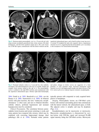 2004; Gould et al. 2005; Breedveld et al. 2006; van der
Knaap et al. 2006; Alamowitch et al. 2009). In bilateral
lesions with glial reactions, the term ‘‘multicystic enceph-
alomalacia’’ is often used, and next to bilateral thrombo-
embolic infarcts, profound hypotension and neonatal
hypoglycemia must be considered.
Clinical Presentation. The correlation between poren-
cephalic lesion location and seizure semiology is weak, and
many patients have temporal lobe seizures, which may be
explained with coexisting hippocampal damage (dual
pathology) (Ho et al. 1998). Perinatal stroke patients
typically present with congenital or early acquired hemi-
paresis or hemiplegia.
Imaging. Porencephalic lesions are CSF-ﬁlled cystic
lesions with minimal surrounding gliosis that communicate
with the lateral ventricle, the subarachnoid space, or both.
The adjacent cortex is atrophic and may be dysplastic
(Figs. 2–4).
Encephalomalacia can be macrocystic or microcystic.
Macrocystic encephalomalacia is characterized by cavi-
tary lesions with CSF-like signal and increased FLAIR
signal intensity lining the CSF-ﬁlled cavities. Microcystic
Fig. 4 Parietooccipital porencephalic cyst in a 15-year-old girl with
drug-resistant secondarily generalized tonic–clonic seizures, left-sided
hemiparesis, and left lower quadrant anopia (a–c). The cystic lesion
has a CSF-like signal, communicates with the lateral ventricle and the
superﬁcial subarachnoid space, and is lined by glitoic tissue (a arrow).
A coronal T2-weighted fast spin echo sequence shows a hypointense
structure (c arrow), suggesting that the porencephalic cyst is secondary
to the resorption of an intracerebral hemorrhage
Fig. 5 Postnatal ischemic stroke in a 3-year-old boy who suddenly
developed a left-sided hemiparesis at the age of 2 months. Simple and
complex focal seizures started at the age of 4. The porencephalic
cavity is conﬁned to the right MCA territory and communicates with
the superﬁcial subarachnoid space. Distinct right-sided hemiatrophy
and gliotic changes (c hollow arrow) are suggestive of a fetal,
perinatal, or early postnatal origin. Increased peritrigonal signal
intensity (c arrow) and hippocampal atrophy and signal increase of the
CA1 sector (a, b arrow) indicate hypoxic-ischemic encephalopathy
Ischemia 197
 