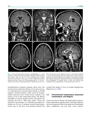 encephalomalacia designates damaged, gliotic brain with
increased water content but without overt cavitary necrosis.
It is characterized by increased signal intensity on FLAIR
sequences. Perinatal ischemic stroke caused by thrombo-
embolic infarction shows cavitary lesions conﬁned to the
territory of one or more intracerebral arteries. The affected
hemisphere is severely atrophic and the corticospinal tract
extremely thin (Fig. 5). Microcystic, gliotic cortical and
subcortical signal changes in a watershed parasagittal dis-
tribution are in favor of moderate neonatal hypoxia/hypo-
tension (Fig. 8) and those with prominent parietal and
occipital lobe changes in favor of neonatal hypoglycemia
(Barkovich et al. 1998).
1.3 Periventricular Leukomalacia, Subcortical
Leukomalacia, and Ulegyria
Clinical presentation. Patients with milder grades of periven-
tricular leukomalacia typically present with spastic diparesis
and visual impairment. More severe grades have leg-dominant
spastic quadriparesis and may show severe cognitive
Fig. 6 Less profound hypoxic-ischemic encephalopathy of a term
newborn. A 20-year-old woman presented with drug-resistant temporal
lobe seizures since the age of 8. Past medical history revealed
successful resuscitation at the age of 2 weeks. MRI showed gliotic
changes and tissue volume loss of both hippocampi (R [ L) (a–c tri-
angles) and of the pre- and postcentral gyri, respectively (c–e arrows).
Note that the cortex in the depth of the sulci is more heavily affected
(c arrow). Gliotic changes and tissue volume loss are due to selective
neuronal loss and the sequelae of the high O2 and metabolic demand
due to the fact that the pre- and postcentral gyri are myelinating around
birth. Midsagittal T1-weighted shows a rather thin callosal body
resulting from the degeneration of transcallosal axons (f arrow)
198 H. Urbach
 
