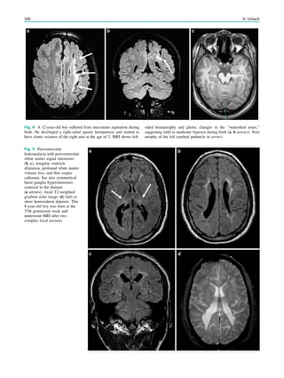 Fig. 8 A 12-year-old boy suffered from meconium aspiration during
birth. He developed a right-sided spastic hemiparesis and started to
have clonic seizures of the right arm at the age of 2. MRI shows left-
sided hemiatrophy and gliotic changes in the ‘‘watershed areas,’’
suggesting mild to moderate hypoxia during birth (a, b arrows). Note
atrophy of the left cerebral peduncle (c arrow)
Fig. 9 Periventricular
leukomalacia with periventricular
white matter signal intensities
(b, c), irregular ventricle
dilatation, profound white matter
volume loss, and thin corpus
callosum. See also symmetrical
basal ganglia hyperintensities
centered in the thalami
(a arrows). Axial T2-weighted
gradient echo image (d) fails to
show hemosiderin deposits. This
8-year-old boy was born at the
37th gestational week and
underwent MRI after two
complex focal seizures
200 H. Urbach
 