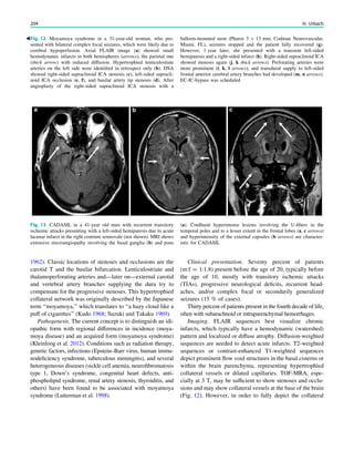 1962). Classic locations of stenoses and occlusions are the
carotid T and the basilar bifurcation. Lenticulostriate and
thalamoperforating arteries and—later on—external carotid
and vertebral artery branches supplying the dura try to
compensate for the progressive stenoses. This hypertrophied
collateral network was originally described by the Japanese
term ‘‘moyamoya,’’ which translates to ‘‘a hazy cloud like a
puff of cigarettes’’ (Kudo 1968; Suzuki and Takaku 1969).
Pathogenesis. The current concept is to distinguish an idi-
opathic form with regional differences in incidence (moya-
moya disease) and an acquired form (moyamoya syndrome)
(Kleinloog et al. 2012). Conditions such as radiation therapy,
genetic factors, infections (Epstein–Barr virus, human immu-
nodeﬁciency syndrome, tuberculous meningitis), and several
heterogeneous diseases (sickle cell anemia, neuroﬁbromatosis
type 1, Down’s syndrome, congenital heart defects, anti-
phospholipid syndrome, renal artery stenosis, thyroiditis, and
others) have been found to be associated with moyamoya
syndrome (Lutterman et al. 1998).
Clinical presentation. Seventy percent of patients
(m:f = 1:1.8) present before the age of 20, typically before
the age of 10, mostly with transitory ischemic attacks
(TIAs), progressive neurological deﬁcits, recurrent head-
aches, and/or complex focal or secondarily generalized
seizures (15 % of cases).
Thirty percent of patients present in the fourth decade of life,
often with subarachnoid or intraparenchymal hemorrhages.
Imaging. FLAIR sequences best visualize chronic
infarcts, which typically have a hemodynamic (watershed)
pattern and localized or diffuse atrophy. Diffusion-weighted
sequences are needed to detect acute infarcts. T2-weighted
sequences or contrast-enhanced T1-weighted sequences
depict prominent ﬂow void structures in the basal cisterns or
within the brain parenchyma, representing hypertrophied
collateral vessels or dilated capillaries. TOF-MRA, espe-
cially at 3 T, may be sufﬁcient to show stenoses and occlu-
sions and may show collateral vessels at the base of the brain
(Fig. 12). However, in order to fully depict the collateral
bFig. 12 Moyamoya syndrome in a 31-year-old woman, who pre-
sented with bilateral complex focal seizures, which were likely due to
cerebral hypoperfusion. Axial FLAIR image (a) showed small
hemodynamic infarcts in both hemispheres (arrows), the parietal one
(thick arrow) with reduced diffusion. Hypertrophied lenticulostiate
arteries on the left side were identiﬁed in retrospect only (b). DSA
showed right-sided supraclinoid ICA stenosis (c), left-sided supracli-
noid ICA occlusion (e, f), and basilar artery tip stenosis (d). After
angioplasty of the right-sided supraclinoid ICA stenosis with a
balloon-mounted stent (Pharos 3 9 13 mm, Codman Neurovascular,
Miami, FL), seizures stopped and the patient fully recovered (g).
However, 1 year later, she presented with a transient left-sided
hemiparesis and a right-sided infarct (h). Right-sided supraclinoid ICA
showed stenosis again (j, k thick arrows). Perforating arteries were
more prominent (i, k, l arrows), and transdural supply to left-sided
frontal anterior cerebral artery branches had developed (m, n arrows).
EC-IC-bypass was scheduled
Fig. 13 CADASIL in a 41-year old man with recurrent transitory
ischemic attacks presenting with a left-sided hemiparesis due to acute
lacunar infarct in the right centrum semiovale (not shown). MRI shows
extensive microangiopathy involving the basal ganglia (b) and pons
(a). Conﬂuent hyperintense lesions involving the U-ﬁbers in the
temporal poles and to a lesser extent in the frontal lobes (a, c arrows)
and hyperintensity of the external capsules (b arrows) are character-
istic for CADASIL
204 H. Urbach
 