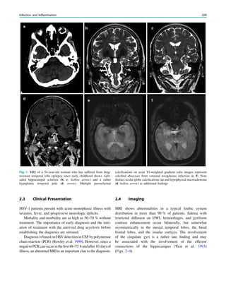 2.3 Clinical Presentation
HSV-1 patients present with acute monophasic illness with
seizures, fever, and progressive neurologic deﬁcits.
Mortality and morbidity are as high as 50–70 % without
treatment. The importance of early diagnosis and the initi-
ation of treatment with the antiviral drug acyclovir before
establishing the diagnosis are stressed.
Diagnosis is based on HSV detection in CSF by polymerase
chain reaction (PCR) (Rowley et al. 1990). However, since a
negativePCRcanoccurintheﬁrst48–72 handafter10 daysof
illness, an abnormal MRI is an important clue to the diagnosis.
2.4 Imaging
MRI shows abnormalities in a typical limbic system
distribution in more than 90 % of patients. Edema with
restricted diffusion on DWI, hemorrhages, and gyriform
contrast enhancement occur bilaterally, but somewhat
asymmetrically in the mesial temporal lobes, the basal
frontal lobes, and the insular cortices. The involvement
of the cingulate gyri is a rather late ﬁnding and may
be associated with the involvement of the efferent
connections of the hippocampus (Tien et al. 1993)
(Figs. 2–4).
Fig. 1 MRI of a 54-year-old woman who has suffered from drug-
resistant temporal lobe epilepsy since early childhood shows right-
sided hippocampal sclerosis (b, c: hollow arrow) and a rather
hypoplastic temporal pole (d: arrow). Multiple parenchymal
calciﬁcations on axial T2-weighted gradient echo images represent
calciﬁed abscesses from connatal toxoplasma infection (e, f). Note
distinct ocular globe calciﬁcations (a) and hypophyseal macroadenoma
(d: hollow arrow) as additional ﬁndings
Infection and Inflammation 209
 