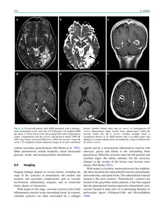 without secondary generalisation) (Del Brutto et al. 1992).
Other presentations include headache, raised intracranial
pressure, stroke, and neuropsychiatric disturbances.
6.4 Imaging
Imaging ﬁndings depend on several factors, including the
stage of the cysticerci at presentation, the number and
location, and associated complications such as vascular
involvement, inﬂammatory response, and, in ventricular
forms, degree of obstruction.
With respect to the stage, vesicular cysticerci elicit little
inﬂammatory reaction in the surrounding tissue. In contrast,
colloidal cysticerci are often surrounded by a collagen
capsule and by a mononuclear inﬂammatory reaction with
astrocytic gliosis and edema in the surrounding brain
parenchyma. When the cysticerci enter into the granular and
calciﬁed stages, the edema subsides, but the astrocytic
changes in the vicinity of the lesions may become more
intense (Del Brutto 2012).
With respect to location, neurocysticercosis has tradition-
ally been classiﬁed into subarachnoid-cisternal, parenchymal,
intraventricular, and spinal forms. The subarachnoid-cisternal
location is the most common. ‘‘Parenchymal’’ cysticerci are
located at the gray/white matter junction; it has been argued
that the parenchymal location represents subarachnoid cysti-
cercosis located in deep sulci or in perforating branches of
perivascular spaces (Villagran-Uribe and Olvera-Rabiela
1988).
Fig. 6 A 54-year-old patient with AIDS presented with a homony-
mous hemianopia to the right side of 8 h‘duration. T2-weighted MRI
(a) shows a 15-mm lesion in the left occipital lobe with a hyperintense
center, a hypointense wall (a: arrows), and perifocal edema. DWI (b:
ADC map) shows increased diffusivity within the necrotic center (b:
arrow). T1-weighted contrast-enhanced images (c–e) show multifocal
lesions. Smaller lesions show ring (c: arrow) or homogeneous (f:
arrow) enhancement; larger lesions show enhancement within the
necrotic center also (d, e: arrow). Another example shows a
toxoplasma abscess in an AIDS patient with a so-called target sign
deﬁned as a central enhancement surrounded by a ring of enhancement
(f: hollow arrow)
214 H. Urbach
 