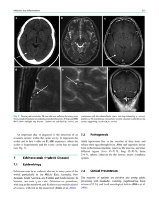 An important clue to diagnosis is the detection of an
eccentric nodule within the cystic cavity. It represents the
scolex and is best visible on FLAIR sequences, where the
scolex is hyperintense and the cystic cavity has no signal
(see Fig. 7).
7 Echinococcosis (Hydatid Disease)
7.1 Epidemiology
Echinococcosis is an endemic disease in many parts of the
world, particularly in the Middle East, Australia, New
Zealand, South America, and Central and South Europe. In
humans, two main types exist: Echinococcos granulosus,
with dog as the main host, and Echinococcus multilocularis/
alveolaris, with fox as the main host (Bükte et al. 2004).
7.2 Pathogenesis
Adult tapeworms live in the intestine of their hosts and
release their eggs through feces. After oral ingestion, larvae
form in the human intestine, penetrate the mucosa, and enter
different organs (liver 50–70 %, lung 15–30 %, brain
2–6 %, spleen, kidneys) via the venous and/or lymphatic
system.
7.3 Clinical Presentation
The majority of patients are children and young adults
presenting with headache, vomiting, papilloedema, focal
seizures (33 %), and focal neurological deﬁcits (Bükte et al.
2004).
Fig. 7 Neurocysticercosis in a 54-year-old man suffering for many years
fromcomplex focal and secondarily generalized seizures. CT(a) and MRI
(b–f) show multiple tiny lesions. Lesions are calciﬁed (a: arrow), are
contiguous with the subarachnoid space, are ring-enhancing (c: arrow),
and have a T2-hypointense rim and an excentric structure within the cystic
cavity, suggesting a scolex (d, e: arrow)
Infection and Inflammation 215
 