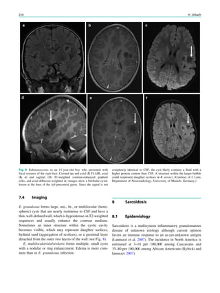 7.4 Imaging
E. granulosus forms large, uni-, bi-, or multilocular (hemi-
spheric) cysts that are nearly isointense to CSF and have a
thin, well-deﬁned wall, which is hypointense on T2-weighted
sequences and usually enhance the contrast medium.
Sometimes an inner structure within the cystic cavity
becomes visible, which may represent daughter scolices,
hydatid sand (aggregation of scolices), or a germinal layer
detached from the outer two layers of the wall (see Fig. 8).
E. multilocularis/alveolaris forms multiple, small cysts
with a nodular or ring enhancement. Edema is more com-
mon than in E. granulosus infection.
8 Sarcoidosis
8.1 Epidemiology
Sarcoidosis is a multisystem inﬂammatory granulomatous
disease of unknown etiology although current opinion
favors an immune response to an as-yet-unknown antigen
(Lannuzzi et al. 2007). The incidence in North America is
estimated at 3–10 per 100,000 among Caucasians and
35–80 per 100,000 among African Americans (Rybicki and
Iannuzzi 2007).
Fig. 8 Echinococcosis in an 11-year-old boy who presented with
focal seizures of the right face. Coronal (a) and axial (f) FLAIR, axial
(b, e) and sagittal (D) T1-weighted contrast-enhanced gradient
echo, and axial diffusion-weighted (c) images show a bilobular cystic
lesion at the base of the left precentral gyrus. Since the signal is not
completely identical to CSF, the cyst likely contains a ﬂuid with a
higher protein content than CSF. A structure within the larger bubble
could respresent daughter scolices (c–f: arrow). (Courtesy of J. Linn,
Department of Neuroradiology, University of Munich, Germany.)
216 H. Urbach
 