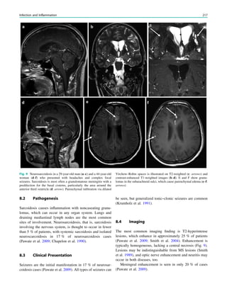 8.2 Pathogenesis
Sarcoidosis causes inﬂammation with noncaseating granu-
lomas, which can occur in any organ system. Lungs and
draining mediastinal lymph nodes are the most common
sites of involvement. Neurosarcoidosis, that is, sarcoidosis
involving the nervous system, is thought to occur in fewer
than 5 % of patients, with systemic sarcoidosis and isolated
neuroscarcoidosis in 17 % of neurosarcoidosis cases
(Pawate et al. 2009; Chapelon et al. 1990).
8.3 Clinical Presentation
Seizures are the initial manifestation in 17 % of neurosar-
coidosis cases (Pawate et al. 2009). All types of seizures can
be seen, but generalized tonic–clonic seizures are common
(Krumholz et al. 1991).
8.4 Imaging
The most common imaging ﬁnding is T2-hyperintense
lesions, which enhance in approximately 25 % of patients
(Pawate et al. 2009; Smith et al. 2004). Enhancement is
typically homogeneous, lacking a central necrosis (Fig. 9).
Lesions may be indistinguishable from MS lesions (Smith
et al. 1989), and optic nerve enhancement and neuritis may
occur in both diseases, too.
Meningeal enhancement is seen in only 20 % of cases
(Pawate et al. 2009).
Fig. 9 Neurosarcoidosis in a 29-year-old man (a–c) and a 44-year-old
woman (d–f) who presented with headaches and complex focal
seizures. Sarcoidosis is most often a granulomatous meningitis with a
predilection for the basal cisterns, particularly the area around the
anterior third ventricle (d: arrow). Parenchymal inﬁltration via dilated
Virchow–Robin spaces is illustrated on T2-weighted (c: arrows) and
contrast-enhanced T1-weighted images (b–d). E and F show granu-
lomas in the subarachnoid sulci, which cause parenchymal edema (e–f:
arrows)
Infection and Inflammation 217
 