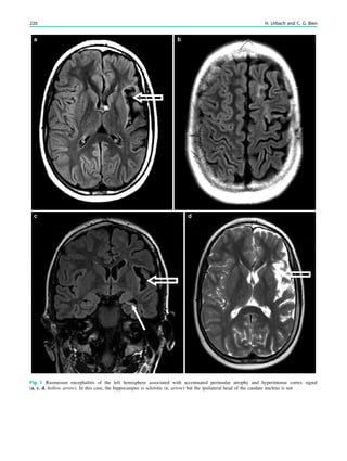 Fig. 1 Rasmussen encephalitis of the left hemisphere associated with accentuated perinsular atrophy and hyperintense cortex signal
(a, c, d, hollow arrow). In this case, the hippocampus is sclerotic (c, arrow) but the ipsilateral head of the caudate nucleus is not
220 H. Urbach and C. G. Bien
 