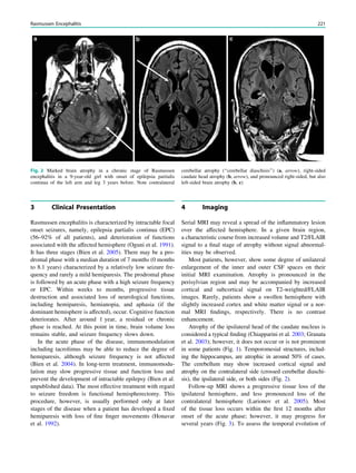 3 Clinical Presentation
Rasmussen encephalitis is characterized by intractable focal
onset seizures, namely, epilepsia partialis continua (EPC)
(56–92% of all patients), and deterioration of functions
associated with the affected hemisphere (Oguni et al. 1991).
It has three stages (Bien et al. 2005). There may be a pro-
dromal phase with a median duration of 7 months (0 months
to 8.1 years) characterized by a relatively low seizure fre-
quency and rarely a mild hemiparesis. The prodromal phase
is followed by an acute phase with a high seizure frequency
or EPC. Within weeks to months, progressive tissue
destruction and associated loss of neurological functions,
including hemiparesis, hemianopia, and aphasia (if the
dominant hemisphere is affected), occur. Cognitive function
deteriorates. After around 1 year, a residual or chronic
phase is reached. At this point in time, brain volume loss
remains stable, and seizure frequency slows down.
In the acute phase of the disease, immunomodulation
including tacrolimus may be able to reduce the degree of
hemiparesis, although seizure frequency is not affected
(Bien et al. 2004). In long-term treatment, immunomodu-
lation may slow progressive tissue and function loss and
prevent the development of intractable epilepsy (Bien et al.
unpublished data). The most effective treatment with regard
to seizure freedom is functional hemispherectomy. This
procedure, however, is usually performed only at later
stages of the disease when a patient has developed a ﬁxed
hemiparesis with loss of ﬁne ﬁnger movements (Honavar
et al. 1992).
4 Imaging
Serial MRI may reveal a spread of the inﬂammatory lesion
over the affected hemisphere. In a given brain region,
a characteristic course from increased volume and T2/FLAIR
signal to a ﬁnal stage of atrophy without signal abnormal-
ities may be observed.
Most patients, however, show some degree of unilateral
enlargement of the inner and outer CSF spaces on their
initial MRI examination. Atrophy is pronounced in the
perisylvian region and may be accompanied by increased
cortical and subcortical signal on T2-weighted/FLAIR
images. Rarely, patients show a swollen hemisphere with
slightly increased cortex and white matter signal or a nor-
mal MRI ﬁndings, respectively. There is no contrast
enhancement.
Atrophy of the ipsilateral head of the caudate nucleus is
considered a typical ﬁnding (Chiapparini et al. 2003; Granata
et al. 2003); however, it does not occur or is not prominent
in some patients (Fig. 1). Temporomesial structures, includ-
ing the hippocampus, are atrophic in around 50% of cases.
The cerebellum may show increased cortical signal and
atrophy on the contralateral side (crossed cerebellar diaschi-
sis), the ipsilateral side, or both sides (Fig. 2).
Follow-up MRI shows a progressive tissue loss of the
ipsilateral hemisphere, and less pronounced loss of the
contralateral hemisphere (Larionov et al. 2005). Most
of the tissue loss occurs within the ﬁrst 12 months after
onset of the acute phase; however, it may progress for
several years (Fig. 3). To assess the temporal evolution of
Fig. 2 Marked brain atrophy in a chronic stage of Rasmussen
encephalitis in a 9-year-old girl with onset of epilepsia partialis
continua of the left arm and leg 3 years before. Note contralateral
cerebellar atrophy (‘‘cerebellar diaschisis’’) (a, arrow), right-sided
caudate head atrophy (b, arrow), and pronounced right-sided, but also
left-sided brain atrophy (b, c)
Rasmussen Encephalitis 221
 