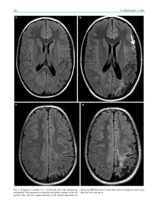 Fig. 3 Progressive atrophy in a 12-year-old girl with Rasmussen
encephalitis. Note progressive tissue loss and gliotic changes in the left
parietal lobe and new signal intensity in the frontal operculum on
follow-up MRI (b, arrow) 5 years after onset of symptoms and 4 years
after the ﬁrst scan (a, c)
222 H. Urbach and C. G. Bien
 