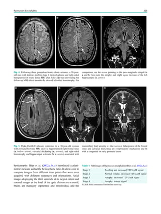 hemiatrophy, Bien et al. (2002a, b, c) introduced a plani-
metric measure called the hemispheric ratio. It allows one to
compare images from different time points that were even
acquired with different sequences and orientations. Axial
images displaying the third ventricle at its largest extent and
coronal images at the level of the optic chiasm are scanned,
brains are manually segmented and thresholded, and the
Fig. 5 Dyke–Davidoff–Masson syndrome in a 30-year-old woman
with perinatal hypoxia. MRI shows a hypertrophied right frontal sinus
(a, hollow arrow), calvarial thickening (a, arrows), and right-sided
hemiatrophy and hippocampal sclerosis (b, c, arrow) associated with
mammillary body atrophy (c, black arrow). Enlargement of the frontal
sinus and calvarial thickening are compensatory mechanism and ﬁt
with a congenital or early postnatal cause
Fig. 4 Following three generalized tonic–clonic seizures, a 28-year-
old man with diabetes mellitus type 1 showed aphasia and right-sided
hemiparesis for hours. Initial MRI after 3 days (a) was unrevealing but
follow-up MRI after 6 months (b) showed left-sided hemiatrophy. For
comparison, see the arrow pointing to the pars marginalis cinguli in
a and b. Also note the atrophy and slight signal increase of the left
hippocampus (c, arrow)
Table 1 MRI stages of Rasmussen encephalitis (Bien et al. 2002a, b, c)
Stage 1 Swelling and increased T2/FLAIR signal
Stage 2 Normal volume, increased T2/FLAIR signal
Stage 3 Atrophy, increased T2/FLAIR signal
Stage 4 Atrophy, normal signal
FLAIR ﬂuid-attenuated inversion recovery
Rasmussen Encephalitis 223
 
