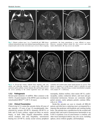 1.3.2 Pathogenesis
Several point mutations of mtDNA: Most common is the
3243A[G point mutation of the MTTL1 gene encoding for
mitochondrial tRNALeu
([80 % of cases).
1.3.3 Clinical Presentation
Clinical triad of (1) stroke-like episodes before 40 years of
age, typically 15 years of age, (2) encephalopathy char-
acterized by seizures (85–90 %), dementia (50–90 %), or
both, and (3) lactic acidosis, ragged red ﬁbers on muscle
biopsy, or both. Other frequent abnormalities include
muscle weakness and early fatigability, sensorineural
hearing loss (25–90 %), mostly axonal sensory peripheral
neuropathy, diabetes mellitus, short stature (80 %), cardio-
myopathy, cardiac conduction defects, and renal and gas-
trointestinal dysfunction. Seizures are commonly simple
partial seizures, rarely epilepsia partialis continua (Riba-
coba et al. 2006).
Stroke-like episodes are seen in virtually all MELAS
patients and often have a stuttering onset, accompanied by a
migraine-like prodrome with headache and vomiting lasting
hours. The episodes have a predilection for the occipital and
parietal lobes and result in homonymous hemianopia in up
to 80 % of patients. Loss of consciousness is common, and
other focal neurological deﬁcits may also occur, including
aphasia, alexia without agraphia, and hemiplegia.
Fig. 1 Glutaric aciduria type 1 in a 7-month-old girl. MRI shows
widened subarachnoid space and subdural hygromas/hematomas in the
temporal poles and over the convexities (a, c: arrows). Due to ongoing
myelination, the brain parenchyma is more difﬁcult to assess.
However, symmteric bilteral striatal (b: short arrows) and white
matter abnormalities (b: long arrows) are notable
Fig. 2 A 20-year-old woman suffered from migraine with aura
attacks and stroke-like epsiodes for several years. MRI showed
symmetric globus pallidus, striatal, thalamic (b), and brainstem lesions
(a: arrows pointing to the central tegmental tract) and diffuse
cerebellar and cerebral white matter signal increase (c: arrows). This
pattern is suggestive of Leigh disease, which is typically an acute
disease in infancy. Muscular biopsy revealed mitochondrial cytopathy
with complex IV [ I deﬁciency
Metabolic Disorders 233
 