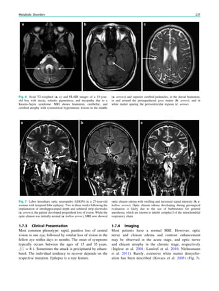 1.7.3 Clinical Presentation
Most common phenotype: rapid, painless loss of central
vision in one eye, followed by similar loss of vision in the
fellow eye within days to months. The onset of symptoms
typically occurs between the ages of 15 and 35 years.
#:$ = 8:1. Sometimes the attack is precipitated by etham-
butol. The individual tendency to recover depends on the
respective mutation. Epilepsy is a rare feature.
1.7.4 Imaging
Most patients have a normal MRI. However, optic
nerve and chiasm edema and contrast enhancement
may be observed in the acute stage, and optic nerve
and chiasm atrophy in the chronic stage, respectively
(Inglese et al. 2001; Lamirel et al. 2010; Niehusmann
et al. 2011). Rarely, extensive white matter demyelin-
ation has been described (Kovacs et al. 2005) (Fig. 7).
Fig. 6 Axial T2-weighted (a, c) and FLAIR images of a 15-year-
old boy with ataxia, retinitis pigmentosa, and myopathy due to a
Kearns–Sayre syndrome. MRI shows brainstem, cerebellar, and
cerebral atrophy with symmetrical hyperintense lesions in the middle
(a: arrows) and superior cerebral peduncles, in the dorsal brainstem,
in and around the periaqueductal gray matter (b: arrow), and in
white matter sparing the periventricular regions (c: arrow)
Fig. 7 Leber hereditary optic neuropathy (LHON) in a 27-year-old
woman with temporal lobe epilepsy. Two to three weeks following the
implantation of intrahippocampal depth and subdural strip electrodes
(a: arrows), the patient developed progredient loss of vision. While the
optic chiasm was initially normal (a: hollow arrow), MRI now showed
optic chiasm edema with swelling and increased signal intensity (b, c:
hollow arrow). Optic chiasm edema developing during presurgical
evaluation is likely due to the use of barbiturates for general
anesthesia, which are known to inhibit complex I of the mitochondrial
respiratory chain
Metabolic Disorders 237
 