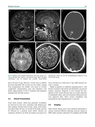 above 50 years of age. However, several cases in children
have been described. The severity can vary widely, ranging
from asymptomatic (for months, even years) to severely
symptomatic (hyperosmolar coma and sometimes even
death). Approximately 15–40 % of patients with nonketotic
hyperglycemia develop seizures.
5.2 Clinical Presentation
Focal motor seizures, which may generalize secondarily,
are observed in most cases, sometimes with epilepsia par-
tialis continua. Seizures may be tonic, clonic, tonic–clonic;
may affect limbs, the face, or one half of the body; and may
be followed by a postictal motor deﬁcit. Seizures are
sometimes elicited or set off by movement, even passive or
active elevation of a limb (arm or leg). EEG between sei-
zures is normal.
Rapid recognition of nonketotic hyperglycemia is vital
because treatment with insulin and rehydration can prevent
negative outcomes. Diagnosis is also essential for man-
agement of the seizures because they are usually refractory
to antiepileptic drugs, and some treatments (phenytoin) may
even aggravate them. These seizures nonetheless stop
spontaneously after hyperglycemia is corrected.
5.3 Imaging
Often normal. Rarely and in close temporal relationship to
seizures restricted diffusion reﬂecting cytotoxic edema on
DWI and/or transient subcortical T2-weighted and FLAIR
Fig. 8 Epilepsy with occipital calciﬁcations and celiac disease in a
12-year-old girl (a–c) and in a 19-year-old woman (d–f). Occipital
calciﬁcations may be bilateral and resemble Sturge–Weber
angiomatosis, which was also the histopathological diagnosis in the
19-year-old woman
Metabolic Disorders 241
 