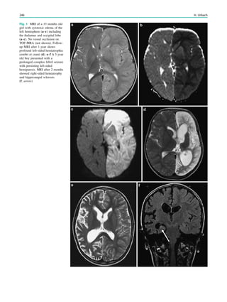 Fig. 1 MRI of a 13 months old
girl with cytotoxic edema of the
left hemisphere (a–c) including
the thalamus and occipital lobe
(a–c). No vessel occlusion on
TOF-MRA (not shown). Follow-
up MRI after 1 year shows
profound left-sided hemiatrophia
cerebri et cranii (d). e–f A 5 year
old boy presented with a
prolonged complex febril seizure
with persisting left-sided
hemiparesis. MRI after 2 months
showed right-sided hemiatrophy
und hippocampal sclerosis
(f: arrow)
246 H. Urbach
 
