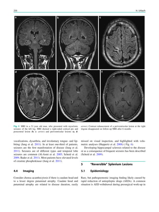 vocalizations, dysarthria, and involuntary tongue- and lip-
biting (Jung et al. 2011). In at least one-third of patients,
seizures are the ﬁrst manifestation of disease (Jung et al.
2011). Seizures are of different types and temporal lobe
seizures are common (Al-Asmi et al. 2005; Scheid et al.
2009; Bader et al. 2011). Most patients have elevated levels
of creatine phosphokinase (Jung et al. 2011).
4.4 Imaging
Consider chorea–acanthocytosis if there is caudate head and
to a lesser degree putaminal atrophy. Caudate head and
putaminal atrophy are related to disease duration, easily
missed on visual inspection, and highlighted with volu-
metric analyses (Huppertz et al. 2008) ( Fig. 6).
Developing hippocampal sclerosis related to the disease
or as a consequence of frequent seizures has been described
(Scheid et al. 2009).
5 ‘‘Reversible’’ Splenium Lesions
5.1 Epidemiology
Rare, but pathognomonic imaging ﬁnding likely caused by
rapid reduction of antiepileptic drugs (AEDs). A common
situation is AED withdrawal during presurgical work-up in
Fig. 3 MRI in a 51 year old man, who presented with myoclonic
seizures of the left leg. MRI showed a right-sided cortical pre and
postcentral lesion (b, c: arrow) and periventricular lesions (a, d:
arrow). Contrast enhancement of a periventricular lesion at the right
trigone disappeared on follow-up MRI after 6 months
250 H. Urbach
 