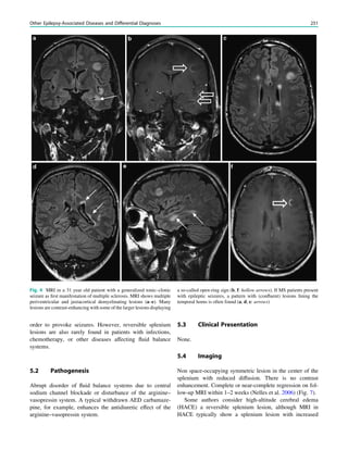 order to provoke seizures. However, reversible splenium
lesions are also rarely found in patients with infections,
chemotherapy, or other diseases affecting ﬂuid balance
systems.
5.2 Pathogenesis
Abrupt disorder of ﬂuid balance systems due to central
sodium channel blockade or disturbance of the arginine–
vasopressin system. A typical withdrawn AED carbamaze-
pine, for example, enhances the antidiuretic effect of the
arginine–vasopressin system.
5.3 Clinical Presentation
None.
5.4 Imaging
Non space-occupying symmetric lesion in the center of the
splenium with reduced diffusion. There is no contrast
enhancement. Complete or near-complete regression on fol-
low-up MRI within 1–2 weeks (Nelles et al. 2006) (Fig. 7).
Some authors consider high-altitude cerebral edema
(HACE) a reversible splenium lesion, although MRI in
HACE typically show a splenium lesion with increased
Fig. 4 MRI in a 31 year old patient with a generalized tonic–clonic
seizure as ﬁrst manifestation of multiple sclerosis. MRI shows multiple
periventricular and juxtacortical demyelinating lesions (a–e). Many
lesions are contrast-enhancing with some of the larger lesions displaying
a so-called open-ring sign (b, f: hollow arrows). If MS patients present
with epileptic seizures, a pattern with (conﬂuent) lesions lining the
temporal horns is often found (a, d, e: arrows)
Other Epilepsy-Associated Diseases and Differential Diagnoses 251
 