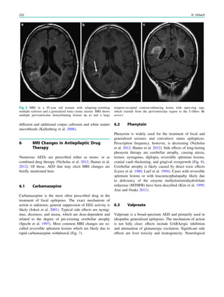 diffusion and additional corpus callosum and white matter
microbleeds (Kallenberg et al. 2008).
6 MRI Changes in Antiepileptic Drug
Therapy
Numerous AEDs are prescribed either as mono- or as
combined drug therapy (Nicholas et al. 2012; Hamer et al.
2012). Of those, AED that may elicit MRI changes are
brieﬂy mentioned here.
6.1 Carbamazepine
Carbamazepine is the most often prescribed drug in the
treatment of focal epilepsies. The exact mechanism of
action is unknown; general suppression of EEG activity is
likely (Jokeit et al. 2001). Typical side effects are nystag-
mus, dizziness, and ataxia, which are dose-dependent and
related to the degree of pre-existing cerebellar atrophy
(Specht et al. 1997). Most common MRI changes are so-
called reversible splenium lesions which are likely due to
rapid carbamazepine withdrawal (Fig. 7).
6.2 Phenytoin
Phenytoin is widely used for the treatment of focal and
generalized seizures and convulsive status epilepticus.
Prescription frequency, however, is decreasing (Nicholas
et al. 2012; Hamer et al. 2012). Side effects of long-lasting
phenyoin therapy are cerebellar atrophy, causing ataxia,
tremor, nystagmus, diplopia, reversible splenium lesions,
cranial vault thickening, and gingival overgrowth (Fig. 8).
Cerebellar atrophy is likely caused by direct toxic effects
(Laxer et al. 1980; Luef et al. 1994). Cases with reversible
splenium lesions or with leucoencephalopathy likely due
to deﬁciency of the enzyme methylenetetrahydrofolate
reductase (MTHFR) have been described (Kim et al. 1999;
Arai and Osaka 2011).
6.3 Valproate
Valproate is a broad-spectrum AED and primarily used in
idiopathic generalized epilepsies. The mechanism of action
is not fully clear; effects include GABAergic inhibition
and attenuation of glutamergic excitation. Signiﬁcant side
effects are liver toxicity and teratogenicity. Neurological
Fig. 5 MRI in a 49 year old woman with relapsing–remitting
multiple sclerosis and a generalized tonic–clonic seizure. MRI shows
multiple periventricular demyelinating lesions (a, c) and a large
temporo-occipital contrast-enhancing lesion with open-ring sign,
which extends from the periventricular region to the U-ﬁbers (b:
arrow)
252 H. Urbach
 