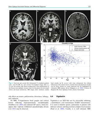 side effects are tremor, parkinsonism, drowsiness, lethargy,
and confusion.
On MRI, T1-hyperintense basal ganglia and cortical
lesions reﬂecting hyperammonemic encephalopathy
(Grubben et al. 2004) and widened CSF spaces, which dis-
appear after valproate withdrawal (pseudoatrophy) (Evans
et al. 2011) may be observed.
6.4 Vigabatrin
Vigabatrin is an AED that acts by irreversibly inhibiting
c-aminobutyric acid transaminase (GABA transaminase).
It is used in infantile spasms, particularly in patients with
tuberous sclerosis and drug-resistant complex focal seizures
(Pearl et al. 2009). Usually, it is well tolerated. MRI
Fig. 6 Axial (a) and coronal (b) reformatted T1-weighted gradient
echo, axial FLAIR (c), and coronal T2-weighted images (d) in a
35 year old woman with chorea–acathocytosis. First manifestation of
the disease were epileptic seizures. Later on, the patient also developed
chorea and facial dyskinesias. MR images show moderate caudate
head atrophy (a, b: arrows) with some enlargement but without
ballooning of the anterior horns. Caudate head and putaminal atrophy
can be easily missed on visual inspection but are highlighted by
volumetric MRI analysis (d, e) (Huppertz et al. 2008). Courtesy of
Huppertz HJ, Swiss Epilepsy Centre, Zurich, Switzerland
Other Epilepsy-Associated Diseases and Differential Diagnoses 253
 