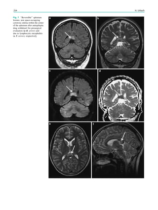 Fig. 7 ‘‘Reversible’’ splenium
lesions: non space-occupying
cytotoxic edema within the center
of the splenium after antiepileptic
drug withdrawl for presurgical
evaluation (a–d: arrow) and
due to lymphocytic encephalitis
(e, f: arrow), respectively
254 H. Urbach
 
