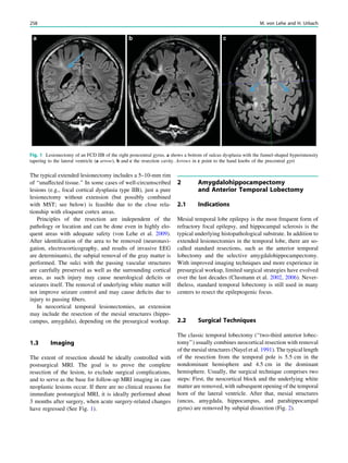 The typical extended lesionectomy includes a 5–10-mm rim
of ‘‘unaffected tissue.’’ In some cases of well-circumscribed
lesions (e.g., focal cortical dysplasia type IIB), just a pure
lesionectomy without extension (but possibly combined
with MST; see below) is feasible due to the close rela-
tionship with eloquent cortex areas.
Principles of the resection are independent of the
pathology or location and can be done even in highly elo-
quent areas with adequate safety (von Lehe et al. 2009).
After identiﬁcation of the area to be removed (neuronavi-
gation, electrocorticography, and results of invasive EEG
are determinants), the subpial removal of the gray matter is
performed. The sulci with the passing vascular structures
are carefully preserved as well as the surrounding cortical
areas, as such injury may cause neurological deﬁcits or
seizures itself. The removal of underlying white matter will
not improve seizure control and may cause deﬁcits due to
injury to passing ﬁbers.
In neocortical temporal lesionectomies, an extension
may include the resection of the mesial structures (hippo-
campus, amygdala), depending on the presurgical workup.
1.3 Imaging
The extent of resection should be ideally controlled with
postsurgical MRI. The goal is to prove the complete
resection of the lesion, to exclude surgical complications,
and to serve as the base for follow-up MRI imaging in case
neoplastic lesions occur. If there are no clinical reasons for
immediate postsurgical MRI, it is ideally performed about
3 months after surgery, when acute surgery-related changes
have regressed (See Fig. 1).
2 Amygdalohippocampectomy
and Anterior Temporal Lobectomy
2.1 Indications
Mesial temporal lobe epilepsy is the most frequent form of
refractory focal epilepsy, and hippocampal sclerosis is the
typical underlying histopathological substrate. In addition to
extended lesionectomies in the temporal lobe, there are so-
called standard resections, such as the anterior temporal
lobectomy and the selective amygdalohippocampectomy.
With improved imaging techniques and more experience in
presurgical workup, limited surgical strategies have evolved
over the last decades (Clusmann et al. 2002, 2006). Never-
theless, standard temporal lobectomy is still used in many
centers to resect the epileptogenic focus.
2.2 Surgical Techniques
The classic temporal lobectomy (‘‘two-third anterior lobec-
tomy’’) usually combines neocortical resection with removal
of the mesial structures (Nayel et al. 1991). The typical length
of the resection from the temporal pole is 5.5 cm in the
nondominant hemisphere and 4.5 cm in the dominant
hemisphere. Usually, the surgical technique comprises two
steps: First, the neocortical block and the underlying white
matter are removed, with subsequent opening of the temporal
horn of the lateral ventricle. After that, mesial structures
(uncus, amygdala, hippocampus, and parahippocampal
gyrus) are removed by subpial dissection (Fig. 2).
Fig. 1 Lesionectomy of an FCD IIB of the right postcentral gyrus. a shows a bottom of sulcus dysplasia with the funnel-shaped hyperintensity
tapering to the lateral ventricle (a arrow), b and c the resection cavity. Arrows in c point to the hand knobs of the precentral gyri
258 M. von Lehe and H. Urbach
 