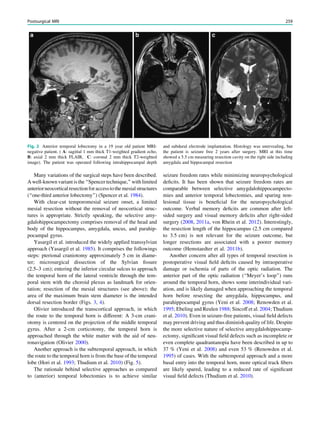 Many variations of the surgical steps have been described.
A well-known variant is the ‘‘Spencer technique,’’ with limited
anteriorneocorticalresectionforaccesstothemesialstructures
(‘‘one-third anterior lobectomy’’) (Spencer et al. 1984).
With clear-cut temporomesial seizure onset, a limited
mesial resection without the removal of neocortical struc-
tures is appropriate. Strictly speaking, the selective amy-
gdalohippocampectomy comprises removal of the head and
body of the hippocampus, amygdala, uncus, and parahip-
pocampal gyrus.
Yasargil et al. introduced the widely applied transsylvian
approach (Yasargil et al. 1985). It comprises the followings
steps: pterional craniotomy approximately 5 cm in diame-
ter; microsurgical dissection of the Sylvian ﬁssure
(2.5–3 cm); entering the inferior circular sulcus to approach
the temporal horn of the lateral ventricle through the tem-
poral stem with the choroid plexus as landmark for orien-
tation; resection of the mesial structures (see above); the
area of the maximum brain stem diameter is the intended
dorsal resection border (Figs. 3, 4).
Olivier introduced the transcortical approach, in which
the route to the temporal horn is different: A 3-cm crani-
otomy is centered on the projection of the middle temporal
gyrus. After a 2-cm corticotomy, the temporal horn is
approached through the white matter with the aid of neu-
ronavigation (Olivier 2000).
Another approach is the subtemporal approach, in which
the route to the temporal horn is from the base of the temporal
lobe (Hori et al. 1993; Thudium et al. 2010) (Fig. 5).
The rationale behind selective approaches as compared
to (anterior) temporal lobectomies is to achieve similar
seizure freedom rates while minimizing neuropsychological
deﬁcits. It has been shown that seizure freedom rates are
comparable between selective amygdalohippocampecto-
mies and anterior temporal lobectomies, and sparing non-
lesional tissue is beneﬁcial for the neuropsychological
outcome. Verbal memory deﬁcits are common after left-
sided surgery and visual memory deﬁcits after right-sided
surgery (2008, 2011a, von Rhein et al. 2012). Interestingly,
the resection length of the hippocampus (2.5 cm compared
to 3.5 cm) is not relevant for the seizure outcome, but
longer resections are associated with a poorer memory
outcome (Hemstaedter et al. 2011b).
Another concern after all types of temporal resection is
postoperative visual ﬁeld deﬁcits caused by intraoperative
damage or ischemia of parts of the optic radiation. The
anterior part of the optic radiation (‘‘Meyer’s loop’’) runs
around the temporal horn, shows some interindividual vari-
ation, and is likely damaged when approaching the temporal
horn before resecting the amygdala, hippocampus, and
parahippocampal gyrus (Yeni et al. 2008; Renowden et al.
1995; Ebeling and Reulen 1988; Sincoff et al. 2004; Thudium
et al. 2010). Even in seizure-free patients, visual ﬁeld defects
may prevent driving and thus diminish quality of life. Despite
the more selective nature of selective amygdalohippocamp-
ectomy, signiﬁcant visual ﬁeld defects such as incomplete or
even complete quadrantanopia have been described in up to
37 % (Yeni et al. 2008) and even 53 % (Renowden et al.
1995) of cases. With the subtemporal approach and a more
basal entry into the temporal horn, more optical track ﬁbers
are likely spared, leading to a reduced rate of signiﬁcant
visual ﬁeld defects (Thudium et al. 2010).
Fig. 2 Anterior temporal lobectomy in a 19 year old patient MRI-
negative patient. ( A: sagittal 1 mm thick T1-weighted gradient echo,
B: axial 2 mm thick FLAIR, C: coronal 2 mm thick T2-weighted
image). The patient was operated following intrahippocampal depth
and subdural electrode implantation. Histology was unrevealing, but
the patient is seizure free 2 years after surgery. MRI at this time
showed a 5.5 cm measuring resection cavity on the right side including
amygdala and hippocampal resection
Postsurgical MRI 259
 