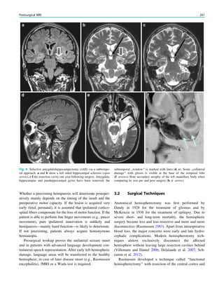 Whether a preexisting hemiparesis will deteriorate postoper-
atively mainly depends on the timing of the insult and the
preoperative motor capacity. If the lesion is acquired very
early (fetal, perinatal), it is assumed that ipsilateral cortico-
spinal ﬁbers compensate for the loss of motor function. If the
patient is able to perform ﬁne ﬁnger movements (e.g., pincer
movement), pure ipsilateral innervation is unlikely and
hemiparesis—mainly hand function—is likely to deteriorate.
If not preexisting, patients always acquire homonymous
hemianopia.
Presurgical workup proves the unilateral seizure onset
and in patients with advanced language development con-
tralateral speech representation. After early left hemispheric
damage, language areas will be transferred to the healthy
hemisphere; in case of later disease onset (e.g., Rasmussen
encephalitis), fMRI or a Wada test is required.
3.2 Surgical Techniques
Anatomical hemispherectomy was ﬁrst performed by
Dandy in 1928 for the treatment of gliomas and by
McKenzie in 1938 for the treatment of epilepsy. Due to
severe short- and long-term mortality, the hemispheric
surgery became less and less resective and more and more
disconnective (Rasmussen 1983). Apart from intraoperative
blood loss, the major concerns were early and late hydro-
cephalic complications. Modern hemispherotomy tech-
niques almost exclusively disconnect the affected
hemisphere without leaving large resection cavities behind
(Villemure and Daniel 2006; Delalande et al. 2007; Sch-
ramm et al. 2012).
Rasmussen developed a technique called ‘‘functional
hemispherectomy’’ with resection of the central cortex and
Fig. 4 Selective amygdalohippocampectomy (sAH) via a subtempo-
ral approach. a and b show a left sided hippocampal sclerosis (open
arrow), c-f the resection cavity one year following surgery. Amygdala,
hippocampus and parahippocampal gyrus have been removed, the
subtemporal ,,window‘‘ is marked with lines (d, e). Some ,,collateral
damage‘‘ with gliosis is visible at the base of the temporal lobe
(f: arrows) Note secondary atrophy of the left mamillary body when
comparing its size pre and post surgery (b, c: arrow)
Postsurgical MRI 261
 