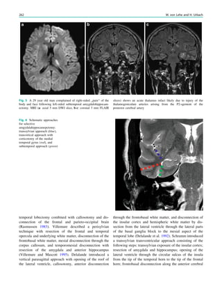temporal lobectomy combined with callosotomy and dis-
connection of the frontal and parieto-occipital brain
(Rasmussen 1983). Villemure described a perisylvian
technique with resection of the frontal and temporal
opercula and underlying white matter, disconnection of the
frontobasal white matter, mesial disconnection through the
corpus callosum, and temporomesial disconnection with
resection of the amygdala and anterior hippocampus
(Villemure and Mascott 1995). Delalande introduced a
vertical parasagittal approach with opening of the roof of
the lateral ventricle, callosotomy, anterior disconnection
through the frontobasal white matter, and disconnection of
the insular cortex and hemispheric white matter by dis-
section from the lateral ventricle through the lateral parts
of the basal ganglia block to the mesial aspect of the
temporal lobe (Delalande et al. 1992). Schramm introduced
a transsylvian transventricular approach consisting of the
following steps: transsylvian exposure of the insular cortex;
resection of amygdala and hippocampus; opening of the
lateral ventricle through the circular sulcus of the insula
from the tip of the temporal horn to the tip of the frontal
horn; frontobasal disconnection along the anterior cerebral
Fig. 5 A 29 year old man complained of right-sided ,,pain‘‘ of the
body and face following left-sided subtemporal amygdalohippocam-
ectomy. MRI (a: axial 5 mm DWI slice, b-c: coronal 3 mm FLAIR
slices) shows an acute thalamus infact likely due to injury of the
thalamogeniculate arteries arising from the P2-sgement of the
posterior cerebral artery
Fig. 6 Schematic approaches
for selective
amgydalahippocamepctomy:
transsylvian apporach (blue),
trancortical approach with
corticotomy of the medial
temporal gyrus (red), and
subtemporal approach (green)
262 M. von Lehe and H. Urbach
 