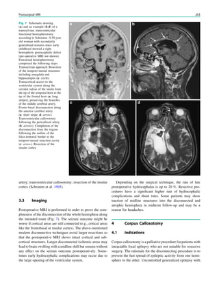 artery; transventricular callosotomy; resection of the insular
cortex (Schramm et al. 1995).
3.3 Imaging
Postoperative MRI is performed in order to prove the com-
pleteness of the disconnection of the whole hemisphere along
the intended route (Fig. 7). The seizure outcome might be
worse if cortical areas are still connected (e.g., critical areas
like the frontobasal or insular cortex). The above-mentioned
modern disconnective techniques avoid larger resections so
that the postoperative MRI shows intact cortical and sub-
cortical structures. Larger disconnected ischemic areas may
lead to brain swelling with a midline shift but remain without
any effect on the seizure outcome postoperatively. Some-
times early hydrocephalic complications may occur due to
the large opening of the ventricular system.
Depending on the surgical technique, the rate of late
postoperative hydrocephalus is up to 20 %. Resective pro-
cedures have a signiﬁcant higher rate of hydrocephalic
complications and shunt rates. Some patients may show
traction of midline structures into the disconnected and
atrophic hemisphere in midterm follow-up and may be a
reason for headaches.
4 Corpus Callosotomy
4.1 Indications
Corpus callosotomy is a palliative procedure for patients with
intractable focal epilepsy who are not suitable for resective
surgery. The rationale for the disconnecting procedure is to
prevent the fast spread of epileptic activity from one hemi-
sphere to the other. Uncontrolled generalized epilepsy with
Fig. 7 Schematic drawing
(a) and an example (b-d) of a
transsylvian, transventricular
functional hemispherotomy
according to Schramm. A 50 year
old woman with secondarily
generalized seizures since early
childhood showed a right
hemispheric porencephalic defect
(pre-operative MRI not shown).
Functional hemispherotomy
comprised the following steps:
Transsylvian approach. Resection
of the temporo-mesial structures
including amygdala and
hippocampus (a: circle).
Transcortical access to the
ventricular system along the
circular sulcus of the insula from
the tip of the temporal horn to the
tip of the frontal horn (a: long
stripes), preserving the branches
of the middle cerebral artery.
Fronto-basal disconnection along
the anterior cerebral artery
(a: short stripe, d: arrow).
Transventricular callosotomy
following the pericallosal artery
(b: arrows). Completion of the
disconnection from the trigone
following the outline of the
falco-tentorial border to the
temporo-mesial resection cavity
(c: arrow). Resection of the
insular cortex
Postsurgical MRI 263
 