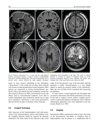 atonic or tonic seizures originating in one hemisphere
(‘‘drop-attacks’’) with a high risk of injury often responds
well in terms of reduced generalized seizure frequency. Most
patients are categorized as having Lennox-Gastaux syn-
drome. Only a few patients become completely seizure-free
after surgery (Cukiert et al. 2006), and sometimes severe side
effects, such as a disconnection syndrome, occur. Due to
modern antiepileptic drug medication and the use of vagal
nerve stimulators, callosotomy is only rarely performed to
date but still has its place in desolate seizure situations.
4.2 Surgical Technique
After dissection of the interhemispheric cleft with preser-
vation of the interhemispheric arteries and bridging veins,
the complete callosum should be exposed for anatomic
orientation. The white matter of the callosum is the visual
guide of the disconnective step of the procedure until the
ependym is visible. Neuronavigation is a very helpful
adjunct to deﬁne the posterior border of the callosotomy.
Here, the vein of Galen will be visualized after transecting
the splenium.
In some centers a staged approach was developed with
an anterior callosotomy (two-thirds) performed as ﬁrst step.
If this fails to improve seizure control, complete discon-
nection is performed (Spencer and Spencer 1989). Different
radiosurgical approaches have been published in the last
decade (Pendl et al. 1999).
4.3 Imaging
Postoperative MRI is performed in order to prove the extent
of the disconnection (two-thirds or complete) (Fig. 8).
Hydrocephalus may be present as a complication due to
Fig. 8 Posterior callosotomy in a 15 year old boy with bilateral
posterior parasagittal ulegyria, a hypoxic ischemic encephalopathy
often due to neonatal hypoglycemia. The goal of callosotomy was to
prevent atonic seizures induced by rapid epileptic discharges
propagating from hemisphere to the other. The extent of callosal
removal is assessed on sagittal T1-weighted images (a: lines).
Posterior parasagittal ulegyria shows shrunken and gliotic gyri,
enlarged sulci, white matter gliosis and volume loss (b-f)
264 M. von Lehe and H. Urbach
 