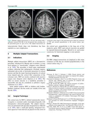 intraventricular blood; deep vein thrombosis has been
reported as a rare complication.
5 Multiple Subpial Transsections
5.1 Indications
Multiple subpial transsections (MST) are a disconnective
procedure, introduced by Morrell and co-workers, to treat
focal epilepsy in ‘‘unresectable’’ eloquent cortex (Morrell
et al. 1989). The procedure is based upon experimental
evidence indicating that epileptogenic discharge requires
substantial side-to-side or horizontal interaction of cortical
neurons and that the major functional properties of cortical
tissue depend upon the vertical ﬁber connections of the
columnar units. MST are mostly combined with resective
surgery near eloquent cortex (Spencer et al. 2002). The
effect on seizure outcome as a standalone procedure is
measurable and may be considered as palliative surgery
(Schramm et al. 2002).
Some authors propose MST in children with Landau-
Kleffner syndrome, but the results are variable (Cross and
Neville 2009).
5.2 Surgical Technique
The cortical area for MST is deﬁned anatomically (neuro-
navigation is essential) and/or electrophysiologically with
intraoperative eletrocorticography. The subpial transsec-
tions are performed with specially designed knives (Morrell
et al. 1989). After a small pial opening, intragriseal inci-
sions spaced at 5-mm intervals are placed over the crown of
the cortical gyri, perpendicular to the long axis of the
respective gyrus. MST (and cortical resection) are guided
by repeated eletrocorticography. Morrell et al. used awake
craniotomy for functional mapping in some patients.
5.3 Imaging
On MRI, subpial transsections are displayed as thin strips
isointense to CSF that are oriented perpendicularly to the
cortical surface (Fig. 9).
References
Clusmann H, Kral T, Schramm J (2006) Present practice and
perspective of evaluation and surgery for temporal lobe epilepsy.
Zentralbl Neurochir 67(4):165–182
Clusmann H, Schramm J, Kral T et al (2002) Prognostic factors and
outcome after different types of resection for temporal lobe
epilepsy. J Neurosurg 97(5):1131–1141
Cross JH, Neville BG (2009) The surgical treatment of Landau–
Kleffner syndrome. Epilepsia 50(Suppl 7):63–67
Cukiert A, Burattini JA, Mariani PP et al (2006) Extended, one-stage
callosal section for treatment of refractory secondarily generalized
epilepsy in patients with Lennox–Gastaut and Lennox-like syn-
dromes. Epilepsia 47(2):371–374
Delalande O, Bulteau C, Dellatolas G et al (2007) Vertical parasagittal
hemispherotomy: surgical procedures and clinical long-term out-
comes in a population of 83 children. Neurosurgery 60(2 Suppl
1):ONS19–ONS32
Delalande O, Pinard JM, Basdevant C et al (1992) Hemispherotomy: a
new procedure fro central disconnection. Epilepsia 33(Suppl3):
99–100
Ebeling U, Reulen HJ (1988) Neurosurgical topography of the optic
radiation in the temporal lobe. Acta Neurochir (Wien) 92:29–36
Egan RA, Shults WT, So N et al (2000) Visual ﬁeld deﬁcits in
conventional anterior temporal lobectomy versus amygdalohippo-
campectomy. Neurology 55:1818–1822
Fig. 9 Multiple subpial transsections in a 26 year old woman with a
subtotally resected FCD IIB of the left parietal lobe extending into
the prescentral gyrus (c: open arrow). The subpial transsections are
visualized as thin stripes in the postcentral gyrus which are isointense
to CSF and oriented perpendicular to the cortical surface (a-c:
arrows)
Postsurgical MRI 265
 