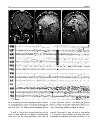 To achieve freedom from seizures following epilepsy
surgery, in some but not all cases not only the epileptogenic
lesion itself but also some perilesional tissue must be
removed. Conceptually, it is the epileptogenic area that has
to be removed, which is deﬁned as cortical area indis-
pensable for the generation of seizures. Practically, it is the
Fig. 2 Epileptogenic lesion and symptomatogenic zone. A 40-year-
old woman suffered from complex focal seizures with a fearful face
and body rocking. The symptoms thus pointed to the mesial frontal
lobe as the origin. MRI shows right-sided hippocampal sclerosis
(a, arrow). Simultaneous video and EEG recordings from interhemi-
spheric (c) and convexity strip and intrahippocampal depth (b) elec-
trodes show seizures starting in the right hippocampus (d, arrow).
Clinical symptoms start around 1 s afterwards (d, asterisk)
22 H. Urbach
 