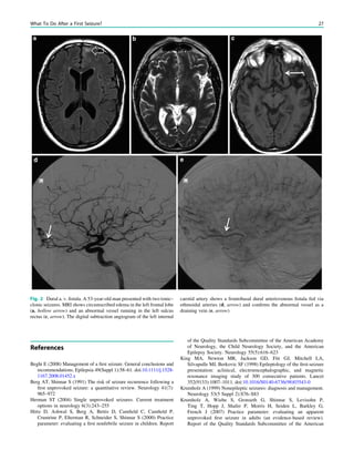 References
Beghi E (2008) Management of a ﬁrst seizure. General conclusions and
recommendations. Epilepsia 49(Suppl 1):58–61. doi:10.1111/j.1528-
1167.2008.01452.x
Berg AT, Shinnar S (1991) The risk of seizure recurrence following a
ﬁrst unprovoked seizure: a quantitative review. Neurology 41(7):
965–972
Herman ST (2004) Single unprovoked seizures. Current treatment
options in neurology 6(3):243–255
Hirtz D, Ashwal S, Berg A, Bettis D, Camﬁeld C, Camﬁeld P,
Crumrine P, Elterman R, Schneider S, Shinnar S (2000) Practice
parameter: evaluating a ﬁrst nonfebrile seizure in children. Report
of the Quality Standards Subcommittee of the American Academy
of Neurology, the Child Neurology Society, and the American
Epilepsy Society. Neurology 55(5):616–623
King MA, Newton MR, Jackson GD, Fitt GJ, Mitchell LA,
Silvapulle MJ, Berkovic SF (1998) Epileptology of the ﬁrst-seizure
presentation: aclinical, electroencephalographic, and magnetic
resonance imaging study of 300 consecutive patients. Lancet
352(9133):1007–1011. doi:10.1016/S0140-6736(98)03543-0
Krumholz A (1999) Nonepileptic seizures: diagnosis and management.
Neurology 53(5 Suppl 2):S76–S83
Krumholz A, Wiebe S, Gronseth G, Shinnar S, Levisohn P,
Ting T, Hopp J, Shafer P, Morris H, Seiden L, Barkley G,
French J (2007) Practice parameter: evaluating an apparent
unprovoked ﬁrst seizure in adults (an evidence-based review).
Report of the Quality Standards Subcommittee of the American
Fig. 2 Dural a. v. ﬁstula. A 53-year-old man presented with two tonic–
clonic seizures. MRI shows circumscribed edema in the left frontal lobe
(a, hollow arrow) and an abnormal vessel running in the left sulcus
rectus (c, arrow). The digital subtraction angiogram of the left internal
carotid artery shows a frontobasal dural arteriovenous ﬁstula fed via
ethmoidal arteries (d, arrow) and conﬁrms the abnormal vessel as a
draining vein (e, arrow)
What To Do After a First Seizure? 27
 