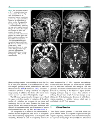 phase-encoding readouts (determined by the reduction fac-
tor R) for a given echo time, or it allows reduction of echo-
train lengths, yielding a shorter, more effective echo time
(Pruessmann et al. 1999; Bammer et al. 2001). This allows a
substantial reduction in image distortion and improves
image quality. In addition, the shorter echo time is more
motion resistant and reduces blurring in the image.
The MR signal is proportional to the square root of R and
the square root of the number of excitations. If R and the
number of excitations are increased, the net signal and
acquisition time are the same. However, the image can
appear different when using parallel data acquisition, and
although the images are noisier, speciﬁc structures of interest
can be assessed better (see Fig. 1 in ‘‘MRI of Children’’).
The susceptibility - is deﬁned as the extent to which a
material becomes magnetized when placed in a magnetic
ﬁeld. The susceptibility is proportional to the magnetic ﬁeld
strength B0; therefore, all kinds of susceptibility artifacts are
more pronounced in 3 T MRI. Important susceptibility-
related artifacts are the signal loss around metallic implants
such as intracranial electrodes and aneurysm clips and
geometric distortions at interfaces between soft tissue and
bone or air, especially at the skull base. Again, parallel-
imaging techniques help to reduce these artifacts by
reducing the echo-train length. Moreover, stronger suscep-
tibility at 3 Tesla facilitates the detection of subtle hemo-
siderin-containing or calciﬁed lesions, which can be
overlooked with 1.5 Tesla scanners.
3 Clinical Practice
Three Tesla scanners generate 2–3-mm-thick slices with
good contrast within an acceptable acquisition time per
sequence. Epilepsy patients are often unable to remain quiet
for sequences lasting longer than around 5 min. The spatial
Fig. 1 The midsagittal image of
a 3D T1-weighted gradient echo
sequence (a) is chosen to align
axial slices parallel to the
commissura anterior–commissura
posterior line. A parasagittal slice
displaying the hippocampus is
chosen to align slices parallel to
the hippocampus (b). An axial
T2-weighted sequence displaying
the inner ear is acquired to avoid
tilting in the coronal plane (c). In
this example, the dotted line
connects the posterior
semicircular canals and shows no
tilting in the coronal plane. Now,
high-resolution coronal slices can
be used for side comparisons.
The 2-mm-thick coronal slice
through the hippocampal heads
(d) shows the semicircular canals
in one plane. A small
hyperintense lesion in the white
matter of the parahippocampal
gyrus just underneath the
hippocampal head (arrow) was
histologically a WHO grade I
ganglioglioma
30 H. Urbach
 