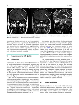 resolution and signal-to-noise ratio are inversely correlated.
If the acquisition time is prolonged, the likelihood of
movement artifacts increases. A reasonable compromise
must be found between image quality and acquisition time.
If movement artifacts prohibit acquisition of images of
sufﬁcient quality, which is particularly common in children,
MRI with general anesthesia is needed.
4 Requirements for MR Quality
4.1 Orientation
Coronal slices are almost always angulated perpendicular to
the hippocampal long axis. To obtain this angulation, we
start with a sagittal sequence, typically a 3D T1-weighted
gradient echo sequence, and use a paramedian slice
displaying the hippocampal long axis for planning. To avoid
tilting in the coronal plane, coronal slices are also adjusted
on an axial plane using symmetrical anatomical structures
such as the semicircular canals or internal auditory canals as
landmarks (Fig. 1).
Axial slices are angulated along the commissura anterior–
commissura posterior line or along the long axis of the hippo-
campus (‘‘temporal angulation’’). Angulation is planned on a
midsagittal slice for commissura anterior–commissura poster-
ior angulation and on a sagittal slice through one hippocampus
for temporal angulation. Temporal angulation on a midsagittal
slice is obtained if slices are acquired along a line from the
dorsal and lower border of the anterior skull base to the callosal
splenium; this angulation is about 25° steeper than commissura
anterior–commissura posterior angulation (Fig. 1).
Most patients with drug-resistant focal epilepsies and
around one third of patients presenting with a ﬁrst epileptic
seizure have temporal lobe epilepsies, with hippocampal
sclerosis being the most commonly operated on lesion
(King et al. 1998). The hippocampus is best displayed on
coronal slices angulated perpendicular to its long axis.
Axial slices along the long axis display the hippocampus on
one slice, whereas with the usual angulation along the
commissura anterior–commissura posterior line hippocam-
pal head, body, and tail are shown on three adjacent, 5-mm
slices.
The recommendation to acquire sequences along or
perpendicular to the hippocampal long axis (‘‘temporal
angulation’’) is somewhat because at the beginning of the
MR era the vast majority of patients with structural
epilepsies had temporal lobe lesions (ILAE recommenda-
tions from 1997 and 1998). In recent years, the percentage of
patients with often subtle cortical dysplasias has steadily
increased. Since cortical dysplasias in the dorsal frontal and
parietal lobes can be missed on axial slices with temporal
angulation, we recommend to acquire an axial ﬂuid-attenuated
inversion recovery (FLAIR) sequence with commissura
anterior–commissura posterior angulation.
4.2 Spatial Resolution
Epileptogenic lesions are often small and do not change
during life. One should bear in mind that lesions with sufﬁ-
cient contrast as compared with the surrounding tissue will be
found if they measure double the pixel size. If the lesion is
smaller, partial volume artifacts may obscure its detection.
Fig. 3 Owing to a lower contrast-to-noise ratio, a faint gray white matter demarcation loss in the left frontal lobe is hardly visible at 1.5 T
(a arrow) compared with 3 T (b arrow, c anterior–posterior extension)
32 H. Urbach
 