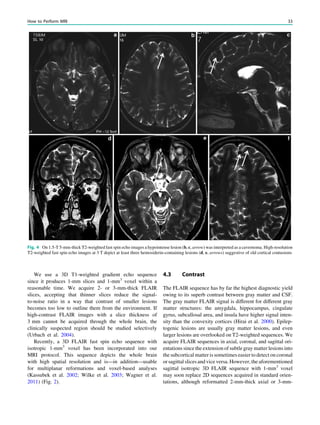 We use a 3D T1-weighted gradient echo sequence
since it produces 1-mm slices and 1-mm3
voxel within a
reasonable time. We acquire 2- or 3-mm-thick FLAIR
slices, accepting that thinner slices reduce the signal-
to-noise ratio in a way that contrast of smaller lesions
becomes too low to outline them from the environment. If
high-contrast FLAIR images with a slice thickness of
3 mm cannot be acquired through the whole brain, the
clinically suspected region should be studied selectively
(Urbach et al. 2004).
Recently, a 3D FLAIR fast spin echo sequence with
isotropic 1-mm3
voxel has been incorporated into our
MRI protocol. This sequence depicts the whole brain
with high spatial resolution and is––in addition––usable
for multiplanar reformations and voxel-based analyses
(Kassubek et al. 2002; Wilke et al. 2003; Wagner et al.
2011) (Fig. 2).
4.3 Contrast
The FLAIR sequence has by far the highest diagnostic yield
owing to its superb contrast between gray matter and CSF.
The gray matter FLAIR signal is different for different gray
matter structures: the amygdala, hippocampus, cingulate
gyrus, subcallosal area, and insula have higher signal inten-
sity than the convexity cortices (Hirai et al. 2000). Epilep-
togenic lesions are usually gray matter lesions, and even
larger lesions are overlooked on T2-weighted sequences. We
acquire FLAIR sequences in axial, coronal, and sagittal ori-
entations since the extension of subtle gray matter lesions into
the subcortical matter is sometimes easier to detect on coronal
or sagittal slices and vice versa. However, the aforementioned
sagittal isotropic 3D FLAIR sequence with 1-mm3
voxel
may soon replace 2D sequences acquired in standard orien-
tations, although reformatted 2-mm-thick axial or 3-mm-
Fig. 4 On 1.5-T 5-mm-thick T2-weighted fast spin echo images a hypointense lesion (b, c, arrow) was interpreted as a cavernoma. High-resolution
T2-weighted fast spin echo images at 3 T depict at least three hemosiderin-containing lesions (d, e, arrows) suggestive of old cortical contusions
How to Perform MRI 33
 