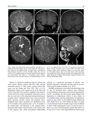 Myelin is a lipid-rich membrane with low protein and
water content. Myelin contains only 40% water, and the
nonmyelin portion of white matter contains about 80%
water (van der Knaap and Valk 1990, 2005, p 1-19).
Myelination begins in the cranial nerves in the ﬁfth fetal
month. It proceeds from caudal to cephalad, from dorsal to
ventral, and from central to peripheral. Functional systems
that are used early in life (precentral and postcentral gyri,
occipital cortex) myelinate before those using association
ﬁbers (posterior parietal, frontal, and temporal areas).
Peripheral white matter myelinates last. Myelination starts
at 9–12 months in the posterior parts, at 11–14 months in
the frontal lobes, and thereafter in the temporal lobes.
Increased white matter signal intensity in the anterior part
of the temporal lobe, which accompanies hippocampal
sclerosis in a signiﬁcant percentage of patients, may
therefore represent a maturation disorder and not an asso-
ciated cortical dysplasia (Schijns et al. 2011).
On MRI, myelination is associated with shortening of the
T1 and T2 relaxation times, reduced water diffusion,
increased diffusion anisotropy, and increased magnetization
transfer. Accordingly, the white matter signal changes from
hypointense to hyperintense relative to gray matter on
T1-weighted images and from hyperintense to hypointense
relative to gray matter on T2-weighted images (Barkovich
2000; Barkovich et al. 1988) During the phase of signal
reversal (between 6 and 18 months of age) it may be difﬁcult
to detect subtle epileptogenic lesions. It may be easier to
detect, e.g., focal cortical dysplasias shortly after birth or at
the age of 2 or 3 years, when signal differences between gray
Fig. 1 Large left frontal focal cortical dysplasia type IIB in a 3-
month-old girl with infantile spasms (West syndrome). The lesion is
best visible on T2-weighted images (a, d–f), easily overlooked on
ﬂuid-attenuated inversion recovery (FLAIR) images (b), and not
visible on T1-weighted images (c). Note the high (inversed) signal of
the unmyelinated white matter on T2-weighted images. Contrast
between gray matter and white matter on T1-weighted images is worse
at 3 T as compared with 1.5 T as the T1 relaxation is around 30%
shorter and the relaxation times of gray matter and white matter
converge. White matter maturation leading to an increased signal
on T1-weighted images starts in the deep white matter posteriorly
and extends latest in the subcortical frontal and temporal lobe white
matter (Barkovich. Pediatric Neuroimaging. Lippincott Williams and
Wilkins, Philadelphia 2000)
MRI of Children 39
 