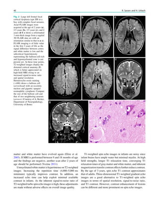 matter and white matter have evolved again (Eltze et al.
2005). If MRI is performed between 9 and 18 months of age
and the ﬁndings are negative, another scan after 2 years of
age should be performed (Vezina 2011).
Unmyelinatedwhite matterishyperintenseonT2-weighted
images. Increasing the repetition time (4,000–5,000 ms
minimum) typically improves contrast. In addition, an
increased echo time can help exploit minimal available
contrast in infants. As the inherent signal-to-noise ratio of
T2-weighted turbo spin echo images is high, these adjustments
are made without adverse effects on overall image quality.
T1-weighted spin echo images in infants are noisy since
infant brains have ample water but minimal myelin. At high
ﬁeld strengths, longer T1 relaxation time, converging T1
relaxation times of gray matter and white matter, and inherent
magnetizationtransfer contrast effectsfurther reduce contrast.
By the age of 3 years, spin echo T1 contrast approximates
that of adults. Three-dimensional T1-weighted gradient echo
images are a good alternative to T1-weighted spin echo
images in terms of spatial resolution, signal-to-noise ratio,
and T1 contrast. However, contrast enhancement of lesions
can be different and more prominent on spin echo images.
Fig. 2 Large left frontal focal
cortical dysplasia type IIB in a
boy with complex focal seizures.
Axial FLAIR images were
acquired at the age of 2 years (a),
2.5 years (b), 3.5 years (c), and 4
years (d–f; e shows a reformatted
1-mm-thick image from a sagittal
3D FLAIR data set with an
orientation similar to that in a–c).
FLAIR imaging is of little value
in the ﬁrst 3 years of life as the
signal difference between cortex
and white matter is low and the
subcortical hyperintensity
representing the balloon-cell-rich
and hypomyelinated zone is not
present yet. At these time points,
T2-weighted images display the
distorted cortical anatomy (f),
which is better appreciated on
high-ﬁeld MRI owing to an
increased signal-to-noise ratio
and spatial resolution.
Hematoxylin–eosin staining
(9400) shows a balloon cell
(arrowhead) with an eccentric
nucleus and gigantic opaque/
eosinophilic cytoplasm. Compare
the size of the balloon cell and
that of two neighboring neurons
(arrows). (Courtesy of A. Becker,
Department of Neuropathology,
University of Bonn)
40 R. Sassen and H. Urbach
 