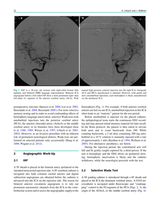 postoperative outcome (Spencer et al. 2000; Lee et al. 2003;
Baxendale et al. 2008, Baxendale 2009 ). For more selective
memory testing and in order to avoid confounding effects of
hemispheric language inactivation, selective Wada tests with
amobarbital injections into the posterior cerebral artery
(PCA), the anterior choroidal artery (AchoA) or the middle
cerebral artery or its branches have been developed (Jack
et al. 1988, 1989; Wieser et al. 1997; Urbach et al. 2001,
2002). However, as an invasive procedure with an inherent
risk of permanent neurological deﬁcits, Wada tests are per-
formed on selected patients only occasionally (Haag et al.
2008; Wagner et al. 2012).
2 Angiographic Work-Up
2.1 IAP
A 5F sheath is placed in the femoral artery ipsilateral to the
intended intracarotid injection side. A 5F vertebral catheter is
navigated into both common carotid arteries and digital
subtraction angiograms are obtained before the catheter is
advanced into the ICA on the injection side. The reason for
bilateral anterior circulation angiograms is to rule out
prominent anastomotic channels from the ICA to the verte-
brobasilar system and to assess the angiographic supply to the
hemispheres (Fig. 1). For example, if both anterior cerebral
arteries are fed via one ICA, amobarbital injection in this ICA
often leads to an ‘‘mutistic’’ patient for the test period.
Before amobarbital is injected via the placed catheter,
the epileptological team starts the continuous EEG record-
ing and may present initial memory material for later recall.
In the Bonn protocol, the patient is then asked to elevate
both arms and to count backwards from 100. While
counting backwards, a 2 ml dose containing 200 mg amo-
barbital in a 10 % solution is manually injected with a rate
of approximately 1 ml/s (Kurthen et al. 1994; Wellmer et al.
2005). For alternative anesthetics, see below.
During the injection period, the contralateral arm will
fall and be gently caught captured by a third person. If the
arm is hemiplegic and the EEG shows an ipsilateral slow-
ing, hemispheric inactivation is likely and the catheter
withdrawn, while the neurologist proceeds with the test.
2.2 Selective Wada Test
A 6F guiding catheter is introduced through a 6F sheath and
placed in the ICA the dominant vertebral artery. A 0.010 mi-
crocatheter is navigated under ﬂuoroscopic and ‘‘roadmap-
ping’’ control in the P2-segment of the PCA (Figs. 2, 3), the
origin of the AChoA, or the middle cerebral artery (Fig. 4).
Fig. 1 IAP in a 28 year old woman with right-sided frontal lobe
epilepsy and bilateral fMRI language representation. Bilateral ICA
angiograms before a left-sided IAP show a more prominent right- than
left-sided A1 segment of the anterior cerebral artery (ACA). With
manual high pressure contrast injection into the right ICA, retrograde
ACA and MCA opaciﬁcation is obtained. However, with gentle and
slow amoabarbital injections, each hemisphere is likely anaesthetized
via the ipsilateral ICA
52 H. Urbach and J. Wellmer
 