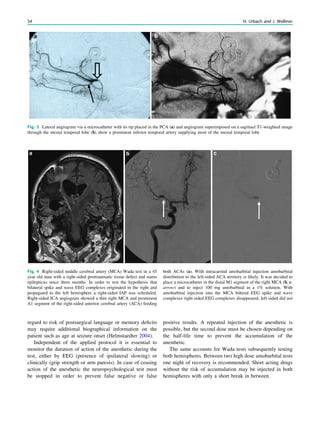 regard to risk of postsurgical language or memory deﬁcits
may require additional biographical information on the
patient such as age at seizure onset (Helmstaedter 2004).
Independent of the applied protocol it is essential to
monitor the duration of action of the anesthetic during the
test, either by EEG (presence of ipsilateral slowing) or
clinically (grip strength or arm paresis). In case of ceasing
action of the anesthetic the neuropsychological test must
be stopped in order to prevent false negative or false
positive results. A repeated injection of the anesthetic is
possible, but the second dose must be chosen depending on
the half-life time to prevent the accumulation of the
anesthetic.
The same accounts for Wada tests subsequently testing
both hemispheres. Between two high dose amobarbital tests
one night of recovery is recommended. Short acting drugs
without the risk of accumulation may be injected in both
hemispheres with only a short break in between.
Fig. 3 Lateral angiogram via a microcatheter with its tip placed in the PCA (a) and angiogram superimposed on a sagittael T1-weighted image
through the mesial temporal lobe (b) show a prominent inferior temporal artery supplying most of the mesial temporal lobe
Fig. 4 Right-sided middle cerebral artery (MCA) Wada test in a 45
year old man with a right-sided posttraumatic tissue defect and status
epilepticus since three months. In order to test the hypothesis that
bilateral spike and wave EEG complexes originated in the right and
propagated to the left hemisphere a right-sided IAP was scheduled.
Right-sided ICA angiogram showed a thin right MCA and prominent
A1 segment of the right-sided anterior cerebral artery (ACA) feeding
both ACAs (a). With intracarotid amobarbital injection amobarbital
distribution to the left-sided ACA territory is likely. It was decided to
place a microcatheter in the distal M1 segment of the right MCA (b, c:
arrow) and to inject 100 mg amobarbital in a 1% solution. With
amobarbital injection into the MCA bilteral EEG spike and wave
complexes right-sided EEG complexes disappeared, left-sided did not
54 H. Urbach and J. Wellmer
 