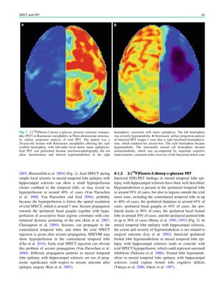 2003; Blumenfeld et al. 2004) (Fig. 2). Ictal SPECT during
simple focal seizures in mesial temporal lobe epilepsy with
hippocampal sclerosis can show a small hyperperfusion
cluster conﬁned to the temporal lobe, or may reveal no
hyperperfusion in around 40% of cases (Van Paesschen
et al. 2000; Van Paesschen and Ictal 2004), probably
because the hyperperfusion is below the spatial resolution
of ictal SPECT, which is around 7 mm. Seizure propagation
towards the ipsilateral basal ganglia together with hypo-
perfusion of associative brain regions correlates with con-
tralateral dystonic posturing of the arm (Kim et al. 2007;
Chassagnon et al. 2009). Seizures can propagate to the
contralateral temporal lobe, and when the ictal SPECT
injection is given after seizure propagation, SISCOM may
show hyperperfusion in the contralateral temporal lobe
(Cho et al. 2010). Early ictal SPECT injection can obviate
this problem of seizure propagation (Van Paesschen et al.
2000). Different propagation patterns in mesial temporal
lobe epilepsy with hippocampal sclerosis are not of prog-
nostic signiﬁcance with respect to seizure outcome after
epilepsy surgery (Kim et al. 2007).
4.1.2 2-[18
F]Fluoro-2-deoxy-D-glucose PET
Interictal FDG-PET ﬁndings in mesial temporal lobe epi-
lepsy with hippocampal sclerosis have been well described.
Hypometabolism is present in the ipsilateral temporal lobe
in around 95% of cases, but also in regions outside the ictal
onset zone, including the contralateral temporal lobe in up
to 40% of cases, the ipsilateral thalamus in around 65% of
cases, ipsilateral basal ganglia in 45% of cases, the ipsi-
lateral insula in 50% of cases, the ipsilateral basal frontal
lobe in around 30% of cases, and the ipsilateral parietal lobe
in up to 30% of cases (Henry et al. 1990, 1993) (Fig. 2). In
mesial temporal lobe epilepsy with hippocampal sclerosis,
the extent and severity of hypometabolism is not related to
surgical outcome (Lee et al. 2002). Interictal ipsilateral
frontal lobe hypometabolism in mesial temporal lobe epi-
lepsy with hippocampal sclerosis tends to coincide with
ictal SPECT hypoperfusion, which could represent surround
inhibition (Nelissen et al. 2006). Frontal lobe hypometab-
olism in mesial temporal lobe epilepsy with hippocampal
sclerosis could explain frontal lobe cognitive deﬁcits
(Takaya et al. 2006; Jokeit et al. 1997).
Fig. 1 2-[18
F]Fluoro-2-deoxy-D-glucose positron emission tomogra-
phy (PET) in Rasmussen encephalitis. a Three-dimensional stereotac-
tic surface projection analysis of ictal PET. The patient was a
26-year-old woman with Rasmussen encephalitis affecting the right
cerebral hemisphere, with left-sided focal motor status epilepticus.
Ictal PET was performed because electroencephalography did not
allow lateralization, and showed hypermetabolism in the right
hemisphere, consistent with status epilepticus. The left hemisphere
was severely hypometabolic. b Stereotactic surface projection analysis
of interictal PET images 1 year after a right functional hemispherot-
omy, which rendered her seizure-free. The right hemisphere became
hypometabolic. The structurally normal left hemisphere became
normometabolic, which was accompanied by important cognitive
improvements, consistent with a recovery of the functional deﬁcit zone
SPECT and PET 65
 