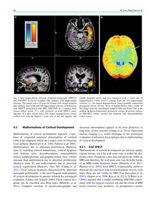 4.2 Malformations of Cortical Development
Malformations of cortical development represent a spec-
trum of congenital structural abnormalities of cerebral
cortical development, which are a major cause of refractory
focal epilepsy (Barkovich et al. 2005; Palmini et al. 2004).
Malformations due to abnormal proliferation (Barkovic
class I), including cortical hamartomas, cortical dysplasia
with balloon cells, dysembryoplastic neuroepithelial
tumors, gangliogliomas, and gangliocytomas, have a better
outcome than malformation due to abnormal proliferation
(Barkovic class II) and malformations due to abnormal
cortical organization (Barkovic class III) (Chang et al.
2011). Focal cortical dysplasia, characterized by abnormal
neuroglial proliferation, is the most frequent malformation
of cortical development in patients referred for presurgical
evaluation (Lüders and Schuele 2006). Focal cortical dys-
plasia can be classiﬁed into three types (Blümcke et al.
2011). Complete resection of electrocorticographic and
structural abnormalities appears to be most predictive of
long-term seizure outcome (Chang et al. 2011). Functional
nuclear imaging is a useful technique in the presurgical
evaluation of refractory focal epilepsy due to malformations
of cortical development.
4.2.1 Ictal SPECT
Malformations of cortical development are intrinsic epilep-
togenic lesions, since the ictal onset zone is within the dys-
plastic cortex. Dysplastic cortex may not always be visible on
MRI and, therefore, the ictal onset zone may be at the border
of an MRI-visible dysplastic lesion (Blümcke et al. 2011;
Marusic et al. 2002). Ictal SPECT is particularly useful to
delineate the ictal onset zone in focal dysplastic lesions, even
when these are not visible on MRI (Van Paesschen et al.
2007a; Dupont et al. 2006; Kim et al. 2011). O’Brien et al.
(2004) reported that a model combining SISCOM concor-
dance with the surgical resection site and the extent of MRI
lesion resection was predictive of postoperative seizure
Fig. 2 Ictal single photon emission computed tomography (SPECT)
and FDG-PET in mesial temporal lobe epilepsy with hippocampal
sclerosis. The patient was a 55-year-old woman with mesial temporal
lobe epilepsy associated with left hippocampal sclerosis. a Subtraction
ictal SPECT coregistered with MRI (SISCOM) of a complex focal
seizure which lasted 73 s, with initiation of ictal SPECT tracer
injection 38 s after seizure onset. The largest hyperperfusion cluster
(yellow–red) with the highest z score was in the left superior and
middle temporal gyrus, and was connected with a small trail of
hyperperfusion (white arrow) coming from the left hippocampal
sclerosis, i.e., the largest hyperperfusion cluster probably represented
propagated seizure activity. Areas of hypoperfusion (blue) visible on
this image were the contralateral temporal lobe and frontal lobe at the
midline. b Three-dimensional stereotactic surface projection analysis
of FDG-PET images showed left temporal lobe hypometabolism
(white arrow)
66 W. Van Paesschen et al.
 