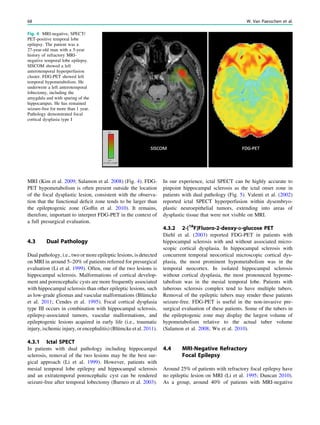 MRI (Kim et al. 2009; Salamon et al. 2008) (Fig. 4). FDG-
PET hypometabolism is often present outside the location
of the focal dysplastic lesion, consistent with the observa-
tion that the functional deﬁcit zone tends to be larger than
the epileptogenic zone (Gofﬁn et al. 2010). It remains,
therefore, important to interpret FDG-PET in the context of
a full presurgical evaluation.
4.3 Dual Pathology
Dual pathology, i.e., two or more epileptic lesions, is detected
on MRI in around 5–20% of patients referred for presurgical
evaluation (Li et al. 1999). Often, one of the two lesions is
hippocampal sclerosis. Malformations of cortical develop-
ment and porencephalic cysts are more frequently associated
with hippocampal sclerosis than other epileptic lesions, such
as low-grade gliomas and vascular malformations (Blümcke
et al. 2011; Cendes et al. 1995). Focal cortical dysplasia
type III occurs in combination with hippocampal sclerosis,
epilepsy-associated tumors, vascular malformations, and
epileptogenic lesions acquired in early life (i.e., traumatic
injury, ischemic injury, or encephalitis) (Blümcke et al. 2011).
4.3.1 Ictal SPECT
In patients with dual pathology including hippocampal
sclerosis, removal of the two lesions may be the best sur-
gical approach (Li et al. 1999). However, patients with
mesial temporal lobe epilepsy and hippocampal sclerosis
and an extratemporal porencephalic cyst can be rendered
seizure-free after temporal lobectomy (Burneo et al. 2003).
In our experience, ictal SPECT can be highly accurate to
pinpoint hippocampal sclerosis as the ictal onset zone in
patients with dual pathology (Fig. 5). Valenti et al. (2002)
reported ictal SPECT hyperperfusion within dysembryo-
plastic neuroepithelial tumors, extending into areas of
dysplastic tissue that were not visible on MRI.
4.3.2 2-[18
F]Fluoro-2-deoxy-D-glucose PET
Diehl et al. (2003) reported FDG-PET in patients with
hippocampal sclerosis with and without associated micro-
scopic cortical dysplasia. In hippocampal sclerosis with
concurrent temporal neocortical microscopic cortical dys-
plasia, the most prominent hypometabolism was in the
temporal neocortex. In isolated hippocampal sclerosis
without cortical dysplasia, the most pronounced hypome-
tabolism was in the mesial temporal lobe. Patients with
tuberous sclerosis complex tend to have multiple tubers.
Removal of the epileptic tubers may render these patients
seizure-free. FDG-PET is useful in the non-invasive pre-
surgical evaluation of these patients. Some of the tubers in
the epileptogenic zone may display the largest volume of
hypometabolism relative to the actual tuber volume
(Salamon et al. 2008; Wu et al. 2010).
4.4 MRI-Negative Refractory
Focal Epilepsy
Around 25% of patients with refractory focal epilepsy have
no epileptic lesion on MRI (Li et al. 1995; Duncan 2010).
As a group, around 40% of patients with MRI-negative
Fig. 4 MRI-negative, SPECT/
PET-positive temporal lobe
epilepsy. The patient was a
27-year-old man with a 5-year
history of refractory MRI-
negative temporal lobe epilepsy.
SISCOM showed a left
anterotemporal hyperperfusion
cluster. FDG-PET showed left
temporal hypometabolism. He
underwent a left anterotemporal
lobectomy, including the
amygdala and with sparing of the
hippocampus. He has remained
seizure-free for more than 1 year.
Pathology demonstrated focal
cortical dysplasia type I
68 W. Van Paesschen et al.
 