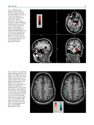 Fig. 5 SISCOM in dual
pathology. The patient was a
36-year-old woman who had
developed epilepsy at the age of
7 years. She underwent a
neurosurgical operation with
removal of a pilocytic
astrocytoma. She remained
seizure-free without antiepileptic
medication until the age of 23
years. She then had recurrent
seizures and developed a
refractory left temporal lobe
epilepsy. SISCOM showed a very
focal cluster of hyperperfusion
(red) in the hippocampus just
posterior of the resection site
(white arrow). This region was
resected, rendering her seizure-
free. Pathology showed
hippocampal sclerosis
Fig. 6 Detection of a small focal
cortical dysplasia guided by ictal
SPECT on an MRI scan that was
initially read as showing normal
ﬁndings. The patient was a 32-
year-old woman with a refractory
right frontal lobe epilepsy. Her
MRI scan of the brain was
initially read as showing normal
ﬁndings. Ictal SPECT was
performed during a motor seizure
that lasted 21 s, with initiation of
the ictal SPECT tracer injection
3 s after seizure onset. SISCOM
showed a hyperperfusion cluster
(red–yellow area) in the right
frontal lobe near primary motor
cortex (motor functional MRI:
blue areas). Reanalysis of the
MRI scan showed a bottom-of-
sulcus cortical dysplasia at the
place of the SISCOM
hyperperfusion cluster
SPECT and PET 69
 
