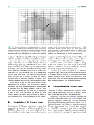 in steps 1–4 and are then averaged. The resulting mean image is
subtracted voxel by voxel from the convolved patient image.
Calculation of the z-score image (step 6). The convolved
images of the controls are also used to calculate a ‘‘standard
deviation image’’ providing standard deviations of the normal
database for all voxels. In the last step, the difference image
from step 5 is divided by this standard deviation image of the
normal database to get the ﬁnal ‘‘junction image’’ with z-score-
normalized data. To avoid outlier values at the border of the
standard brain where only a few subjects contribute to the
normal database and its standard deviation, the standard
deviation image is previously smoothed by using a ﬁxed
Gaussiankernelof6-mmfullwidthathalfmaximum(FWHM).
Bright regions in the junction image primarily corre-
spond to cortical areas with a less deﬁned border between
gray matter and white matter and a broader transition zone
as compared with the normal database. However, other
brain areas (e.g., subcortical structures) may be highlighted
as well if their signal intensities fall within the range
between normal gray matter and white matter as deﬁned in
step 3 and differ from the normal database in this respect.
2.3 Computation of the Extension Image
Smoothing (step 7). The gray matter image resulting from
segmentation is smoothed by a Gaussian kernel of 6-mm
FWHM (i.e., about the size of the lesions to be detected). In
the smoothed gray matter image, each voxel encodes the
average concentration of gray matter from around the voxel
(deﬁned by the form of the smoothing kernel) at the cor-
responding position in the original structural MR image.
Comparison with a normal database (step 8). As in step
5, the mean smoothed gray mater image of the normal
database is subtracted voxel by voxel from the smoothed
gray matter image of the patient investigated.
Calculation of the z-score image (step 9).The difference
image from step 8 is divided by the standard deviation image
of the normal database to obtain z-score-normalized data for
the ﬁnal ‘‘extension image.’’ In this image, those brain areas
appear bright where gray matter extends abnormally into the
white matter as compared with the normal database.
2.4 Computation of the Thickness Image
Conversion to a binary image (step 10). The gray matter
image from segmentation is converted to a binary image
using the ImCalc tool of SPM5 with a cutoff of 0.5.
Estimation of cortical thickness (step 11). Similar to the
method described by Bernasconi et al. (2001), for each voxel
within the gray matter compartment, run-length vectors are
determined in 26 spatial directions from the starting voxel to
the nearest boundary voxel of the gray matter compartment.
To reduce the processing time, the search space is limited
to a cube of 153
voxels centred at the starting voxel. Thus,
all run-length vectors are clipped at a maximum length of
seven voxel units. For each pair of opposing run-length
GM
WM
CSF
1
2
3
4
5 6
7
8
Fig. 2 Two-dimensional illustration of the approach used for estimating
cortical thickness. For each voxel within the gray matter compartment,
run-length vectors are determined in different directions to either the
nearest boundaryvoxel ofthe graymatter compartmentorthe boundaryof
a predeﬁned search space (represented by the checkered area) around the
starting voxel. In this example, opposing run-length vectors 1 and 2
represent the shortest connection between gray matter–white matter
and gray matter–CSF interfaces passing through the starting voxel.
The Euclidean lengths of both vectors are summed and the value obtained
is inserted at the starting voxel in the resulting ‘‘run-length image’’
76 H.-J. Huppertz
 