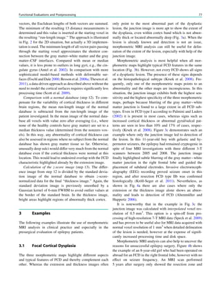 vectors, the Euclidean lengths of both vectors are summed.
The minimum of the resulting 13 distance measurements is
determined and this value is inserted at the starting voxel in
the resulting ‘‘run-length image.’’ The approach is illustrated
in Fig. 2 for the 2D situation, but actually a 3D implemen-
tation is used. The minimum length of all vector pairs passing
through the starting voxel approximates the shortest con-
nection between the gray matter–white matter and the gray
matter–CSF interfaces. Compared with mean or median
values, it is less prone to outliers in long gyri, e.g., the cin-
gulate gyrus (Antel et al. 2002). In comparison with more
sophisticated model-based methods with deformable sur-
faces (Fischl and Dale 2000; Besson et al. 2008a; Thesen et al.
2011), a data-driven approach as described above without the
need to model the cortical surfaces requires signiﬁcantly less
processing time (Scott et al. 2009).
Comparison with a normal database (step 12). To com-
pensate for the variability of cortical thickness in different
brain regions, the mean run-length image of the normal
database is subtracted from the run-length image of the
patient investigated. In the mean image of the normal data-
base all voxels with value zero after averaging (i.e., where
none of the healthy controls have gray matter) are set to a
median thickness value (determined from the nonzero vox-
els). In this way, any abnormality of cortical thickness can
also be assessed in regions where no subject from the normal
database has shown gray matter tissue so far. Otherwise,
unusually deep sulci would differ very much from the normal
database even if the cortical thickness were normal at this
location. This would lead to undesired overlap with the FCD
characteristic highlighted already by the extension image.
Calculation of the z-score image (step 13). The differ-
ence image from step 12 is divided by the standard devia-
tion image of the normal database to obtain z-score-
normalized data for the ﬁnal ‘‘thickness image.’’ Again, the
standard deviation image is previously smoothed by a
Gaussian kernel of 6-mm FWHM to avoid outlier values at
the border of the standard brain. In the thickness image,
bright areas highlight regions of abnormally thick cortex.
3 Examples
The following examples illustrate the use of morphometric
MRI analysis in clinical practice and especially in the
presurgical evaluation of epilepsy patients.
3.1 Focal Cortical Dysplasia
The three morphometric maps highlight different aspects
and typical features of FCD and thereby complement each
other. Whereas the extension and thickness images often
only point to the most abnormal part of the dysplastic
lesion, the junction image is more apt to show the extent of
the dysplasia, even within cortex band which is not abnor-
mally thick or located abnormally deep (Fig. 3a). When the
lesion is already known and detection is not an issue,
morphometric MRI analysis can still be useful for delin-
eation of the extent of the lesion, especially with help of the
junction image.
Morphometric analysis is most helpful when all mor-
phometric maps highlight typical FCD features in the same
location (Fig. 3b). However, not every FCD shows all signs
of a dysplastic lesion. The presence of these signs depends
on the histopathological subtype (Krsek et al. 2008). Fre-
quently, only one of the morphometric maps points to an
abnormality and the other maps are inconspicuous. In this
situation, the junction image exhibits both the highest sen-
sitivity and the highest speciﬁcity of the three morphometric
maps, perhaps because blurring of the gray matter-white
matter junction is found to a large extent in all FCD sub-
types. Even in FCD type I according to Palmini and Luders
(2002) it is present in most cases, whereas signs such as
increased cortical thickness or abnormal gyral/sulcal pat-
terns are seen in less than 10% and 17% of cases, respec-
tively (Krsek et al. 2008). Figure 3c demonstrates such an
example where only the junction image led to detection of
the lesion. In this 11-year-old boy with gelastic and hy-
permotor seizures, the epilepsy had remained cryptogenic in
spite of four MRI investigations with three different 3-T
scanners between 2005 and 2008. The junction image
ﬁnally highlighted subtle blurring of the gray matter-white
matter junction in the right frontal lobe and guided the
placement of subdural electrodes. Invasive electroenceph-
alography (EEG) recording proved seizure onset in this
region, and after resection FCD type IIb was conﬁrmed
histologically (Kröll-Seger et al. 2011). Nevertheless, as
shown in Fig. 4a there are also cases where only the
extension or the thickness image alone shows an abnor-
mality and leads to detection of FCD (Altenmüller and
Huppertz 2006).
It is noteworthy that in the example in Fig. 3c the
junction image was calculated with interpolated voxel res-
olution of 0.5 mm3
. This option is a spin-off from pro-
cessing of high-resolution 7-T MRI data (Speck et al. 2009)
and has proven to be useful also for MRI data acquired with
normal voxel resolution of 1 mm3
when detailed delineation
of the lesion is needed, however at the expense of signiﬁ-
cantly increased processing time and disk space.
Morphometric MRI analysis can also help to uncover the
reasons for unsuccessful epilepsy surgery. Figure 4b shows
the example of an 8-year-old girl who had been operated on
abroad for an FCD in the right frontal lobe, however with no
effect on seizure frequency. An MRI scan performed
5 years after surgery only showed the resection zone and
Functional Evaluations and Postprocessing 77
 