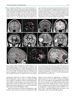 postoperative gliosis but no signs of residual dysplasia.
Only morphometric analysis based on a preoperative MRI
scan revealed in comparison with the coregistered postop-
erative MRI scan that dysplastic tissue has remained in the
right anterior insula just behind the resection zone. This
ﬁnding provides the opportunity for a second and hopefully
ﬁnal resection (Kröll and Huppertz 2008).
Apart from detection of lesions and delineation of the
extent for ﬁnal resection, the results of morphometric MRI
analysis can also guide the implantation of subdural or
depth electrodes for invasive EEG recording and mapping
(Fig. 4a). For this purpose, the morphometric maps which
have been normalized to the SPM5 standard brain during
preprocessing can be transferred back to native space by
inverse normalization and are then ready to be imported into
an intraoperative neuronavigation system (Wellmer et al.
2010). This is especially helpful when the lesion is not
recognizable in the conventional MR sequences.
Fig. 3 Morphometric MRI analysis in focal cortical dysplasia. a T1-
weighted image, extension image, junction image, and postoperative
image in a patient with focal cortical dysplasia (FCD) type IIb. Whereas
the extension image only highlights the ‘‘tip of the iceberg,’’ the junction
image demonstrates the extent of the lesion, ﬁtting well the ﬁnal
resection zone. b T1-weighted, extension, junction, and thickness
images in FCD IIb: the morphometric maps show all the signs of a
dysplastic lesion, i.e., the abnormal gyration, the blurring of the
gray-white matter junction, and the abnormal thickness of the cortical
ribbon. c Coronal and sagittal T1-weighted and junction images (upper
row) and corresponding T2- and ﬂuid-attenuated inversion recovery
(FLAIR)-weighted images (lower row) in a patient with gelastic and
hypermotor seizures of unknown cause in spite of four MRI investiga-
tions with three different 3-T scanners. Only the junction image led to
detection of the lesion. Even retrospectively, the dysplasia is hardly
recognizable in the conventional magnetic resonance images
b
Fig. 4 Further examples of morphometric analysis in FCD. a T1- and
FLAIR-weighted images, extension image, and T1-weighted image
after electrode implantation in a patient with epigastric auras and
hypermotor seizures. The epilepsy was previously cryptogenic in spite
of 1.5- and 3-T MRI. The extension image led to detection of the
lesion by highlighting an abnormally deep sulcus in the left frontal
lobe and guided the placement of a depth electrode in this suspicious
sulcus, which after resection turned out to harbor FCD type IIb. The
very subtle transmantle sign in the FLAIR image was recognized only
retrospectively. b Preoperative FLAIR and postoperative T2 images in
an 8-year-old girl with FCD in the right frontal lobe (upper row). The
comparison of preoperative T1 and junction images with the coreg-
istered postoperative T1 image (lower row) reveals residual dysplastic
tissue posterior to the resection zone
Functional Evaluations and Postprocessing 79
 