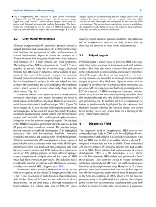 3.2 Gray Matter Heterotopia
Although morphometric MRI analysis is primarily meant to
support detection and visualization of FCD, the method may
also facilitate the recognition of other malformations of
cortical development. Figure 5a shows the example of a
30-year-old man with rare generalized tonic–clonic seizures
with intervals of 1–2 years without any focal symptoms.
The ﬁndings of two MRI investigations at 1.5 and 3 T were
regarded as normal. Only the extension image calculated
from the last MRI scan revealed two subtle nodules of gray
matter in the roofs of the lateral ventricles, representing
bilateral periventricular nodular heterotopia. It is notewor-
thy that morphometric analysis in this case helped not only
to detect the heterotopia but also highlighted the overlying
cortex, which seems to extend abnormally deep into the
white matter (Fig. 5a).
A clear-cut double cortex syndrome with a broad band of
subcortical heterotopic gray metter throughout the brain is
hardly missed in the MRI investigation. But there are also very
subtle forms of subcortical band heterotopia (SBH). Figure 5b
showsimagesofa42-year-oldmansufferingfromseizureswith
metamorphopsia in the lower-left visual ﬁeld. Ictal EEG dem-
onstrated a nonlateralizing seizure pattern over the biposterior
regions and interictal EEG multiregional spike-and-wave
complexes over the posterior temporal regions. The ﬁndings
oftwoMRIinvestigations,performedwhenthemanwas22and
42 years old, were considered normal. The junction image
derived from the second MRI investigation (3 T) highlighted
subcortical thin and discontinuous band-like structures
conﬁned to the parietal and occipital lobes ofboth hemispheres.
After reevaluation of the MRI investigations in these regions, a
partial double cortex syndrome with very subtle SBH in pos-
terior brain regions was diagnosed, thus explaining very well
the ictal visual symptoms and EEG ﬁndings. In a subsequent
survey of 378 epilepsy patients in three different epilepsy
centers, morphometric analysis detected ﬁve cases of SBH
which had been overlooked previously. This indicates that a
considerable number of patients with SBH remain unrecog-
nized by conventional MRI (Huppertz et al. 2008).
Furthermore, subtle forms of SBH such as in Fig. 5b can
only be recognized in thin-sliced T1 images, preferably with
1-mm3
voxel resolution in each direction. Reconstructions
with thicker slices of 3–5 mm are not sufﬁcient to detect
these lesions. On the other hand, a thorough inspection of
high-resolution T1 volume data sets of 150–180 slices
requires special attention, patience, and time. The additional
use of morphometric analysis can help to save time by
directing the attention to these subtle malformations.
3.3 Polymicrogyria
Polymicrogyria is usually easy to detect on MRI, especially
with bilateral presentation or when associated with schizen-
cephaly. But there also subtle circumscribed and unilateral
forms which might go unrecognized, particularly when thin-
sliced T1 images either have not been acquired or––for time-
saving reasons––are discarded in exchange for reconstructed
images of greater slice thickness. Figure 6 shows such an
example of a polymicrogyria which had been overlooked in a
previous MRI investigation and had been misinterpreted as
FCD in a recent 3-T MRI investigation. However, morpho-
metric analysis can not only aid in detecting the lesion (as in
this example) but may also help to differentiate between FCD
and polymicrogyria. In contrast to FCD, a polymicrogyria
lesion is predominantly highlighted by the extension and
thickness images, whereas the junction image (not shown
here) displays no or only scarce hints for a blurring of the
gray-white matter junction.
4 Diagnostic Yield
The diagnostic yield of morphometric MRI analysis was
analyzed prospectively in 2006 at the Swiss Epilepsy Centre.
Morphometric MRI analysis was applied for all patients who
had an MRI scan in that year and for whom a digital T1-
weighted volume data set was available. These constituted
215 out of a total of 363 epilepsy patients who had an MRI
scan in 2006. Thirty patients had malformations of cortical
development (FCD, n = 20; heterotopia, n = 4; others,
n = 6). Morphometric MRI analysis was performed in 26 of
these patients (four dropouts owing to severe movement
artifacts or missing digital MRI data). All malformations were
identiﬁed in the morphometric maps. However, in 16 of these
patients, these malformations had been overlooked in previ-
ous MRI investigations, and in nine of these 16 patients even
in the MRI investigations in 2006, which were the basis for
postprocessing. In an additional seven patients, the epilepto-
genic lesions were misinterpreted concerning their cause and/
or their extension. Overall, this corresponds to a diagnostic
Fig. 5 Morphometric MRI analysis in gray matter heterotopia.
a Sagittal T1- and T2-weighted images with the extension image
(upper row), and coronal T1 and extension images (lower row) in a
patient with bilateral periventricular nodular heterotopia. The heter-
otopia was overlooked in two 1.5- and 3-T MRI investigations and
was only detected with the help of the extension image. b Axial T1
images (upper row), corresponding junction images (middle row), and
enlarged T1 images (lower row) in a patient with very subtle
subcortical band heterotopia not recognized in two previous MRI
investigations. The junction image was not only crucial in establishing
the diagnosis but also helped to assess the extent of these malforma-
tions and to verify the bilateral distribution
b
Functional Evaluations and Postprocessing 81
 