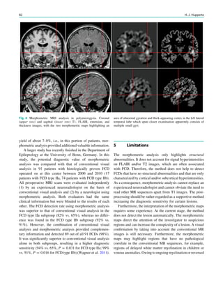 yield of about 7–8%, i.e., in this portion of patients, mor-
phometric analysis provided additional valuable information.
A larger study has recently ﬁnished in the Department of
Epileptology at the University of Bonn, Germany. In this
study, the potential diagnostic value of morphometric
analysis was compared with that of conventional visual
analysis in 91 patients with histologically proven FCD
operated on at this center between 2000 and 2010 (17
patients with FCD type IIa, 74 patients with FCD type IIb).
All preoperative MRI scans were evaluated independently
(1) by an experienced neuroradiologist on the basis of
conventional visual analysis and (2) by a neurologist using
morphometric analysis. Both evaluators had the same
clinical information but were blinded to the results of each
other. The FCD detection rate using morphometric analysis
was superior to that of conventional visual analysis in the
FCD type IIa subgroup (82% vs. 65%), whereas no differ-
ence was found in the FCD type IIb subgroup (92% vs.
91%). However, the combination of conventional visual
analysis and morphometric analysis provided complemen-
tary information and detected 89 out of all 91 FCDs (98%).
It was signiﬁcantly superior to conventional visual analysis
alone in both subgroups, resulting in a higher diagnostic
sensitivity (94% vs. 65%, P = 0.031 for FCD type IIa; 99%
vs. 91%, P = 0.016 for FCD type IIb) (Wagner et al. 2011).
5 Limitations
The morphometric analysis only highlights structural
abnormalities. It does not account for signal hyperintensities
on FLAIR and/or T2 images, which are often associated
with FCD. Therefore, the method does not help to detect
FCDs that have no structural abnormalities and that are only
characterized by cortical and/or subcortical hyperintensities.
As a consequence, morphometric analysis cannot replace an
experienced neuroradiologist and cannot obviate the need to
read other MR sequences apart from T1 images. The post-
processing should be rather regarded as a supportive method
increasing the diagnostic sensitivity for certain lesions.
Furthermore, the interpretation of the morphometric maps
requires some experience. At the current stage, the method
does not detect the lesion automatically. The morphometric
maps direct the attention of the investigator to suspicious
regions and can increase the conspicuity of a lesion. A visual
conﬁrmation by taking into account the conventional MR
images is still necessary. Furthermore, the morphometric
maps may highlight regions that have no pathological
correlate in the conventional MR sequences, for example,
regions of delayed white matter myelination in children or
venous anomalies. Owing to ongoing myelination or reversed
Fig. 6 Morphometric MRI analysis in polymicrogyria. Coronal
(upper row) and sagittal (lower row) T1, FLAIR, extension, and
thickness images, with the two morphometric maps highlighting an
area of abnormal gyration and thick-appearing cortex in the left lateral
temporal lobe which upon closer examination apparently consists of
multiple small gyri
82 H.-J. Huppertz
 